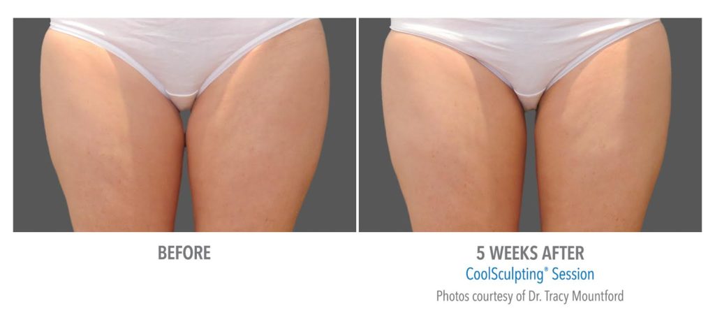 CoolSculpting Los Angeles, Beverly Hills Body Contouring