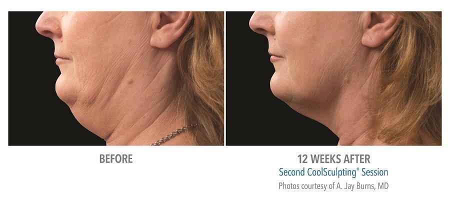 Get Rid of Your Double Chin, Chin Fat Reduction