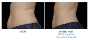CoolSculpting: Risks, side effects, and results