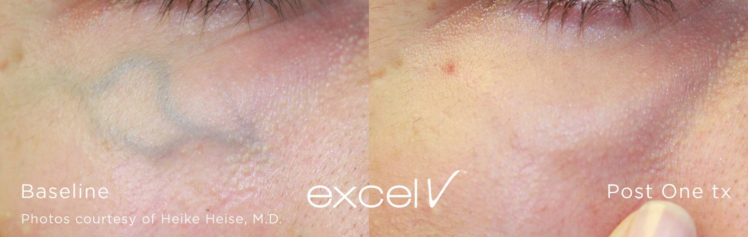 Excel V Vascular Laser Vascular Pigmentation Laser Treatment Before ...