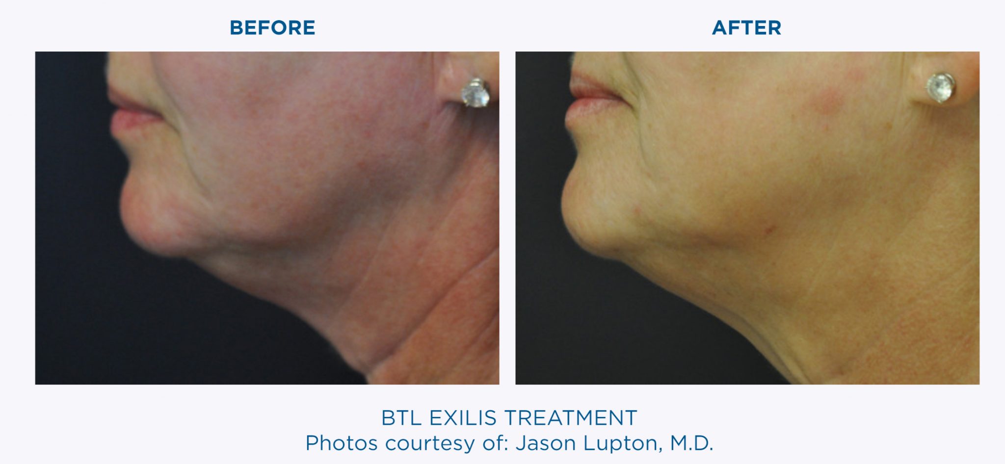 Btl Exilis Ultra Tight For The Delicate Skin Around The Eyes Neck Face And Décolletage 2515