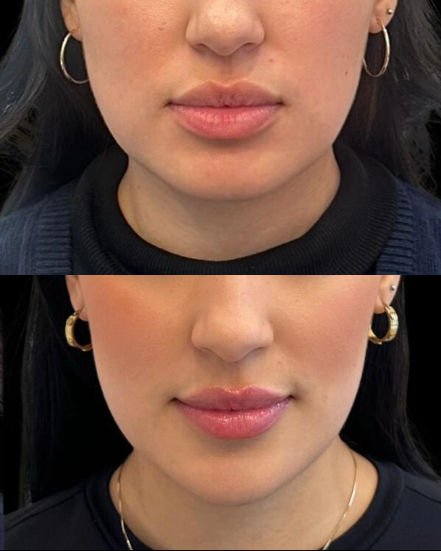 Real Patient Results by Motykie Med Spa serving Beverly Hills & Los Angeles, CA