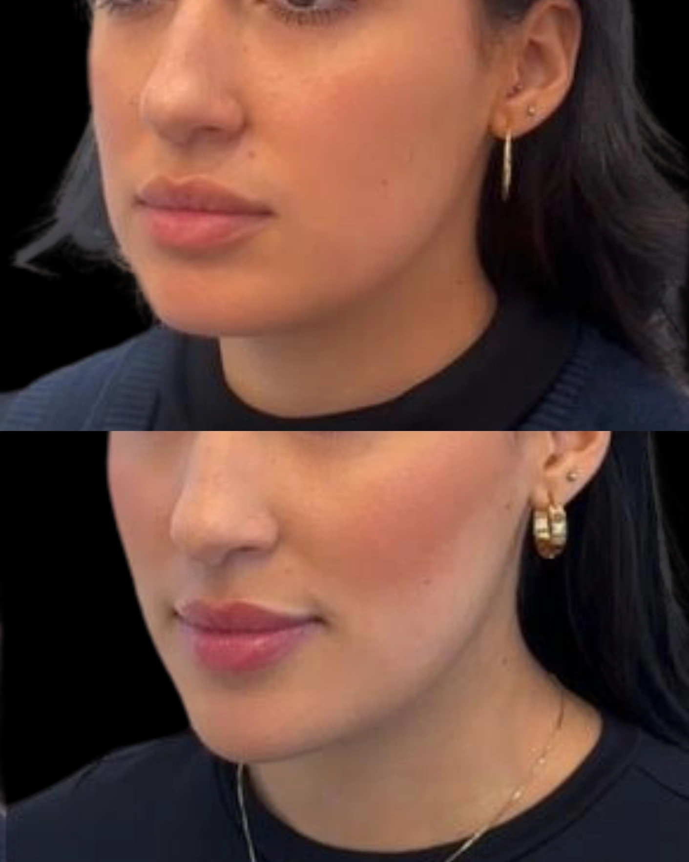 Real Patient Results by Motykie Med Spa serving Beverly Hills & Los Angeles, CA