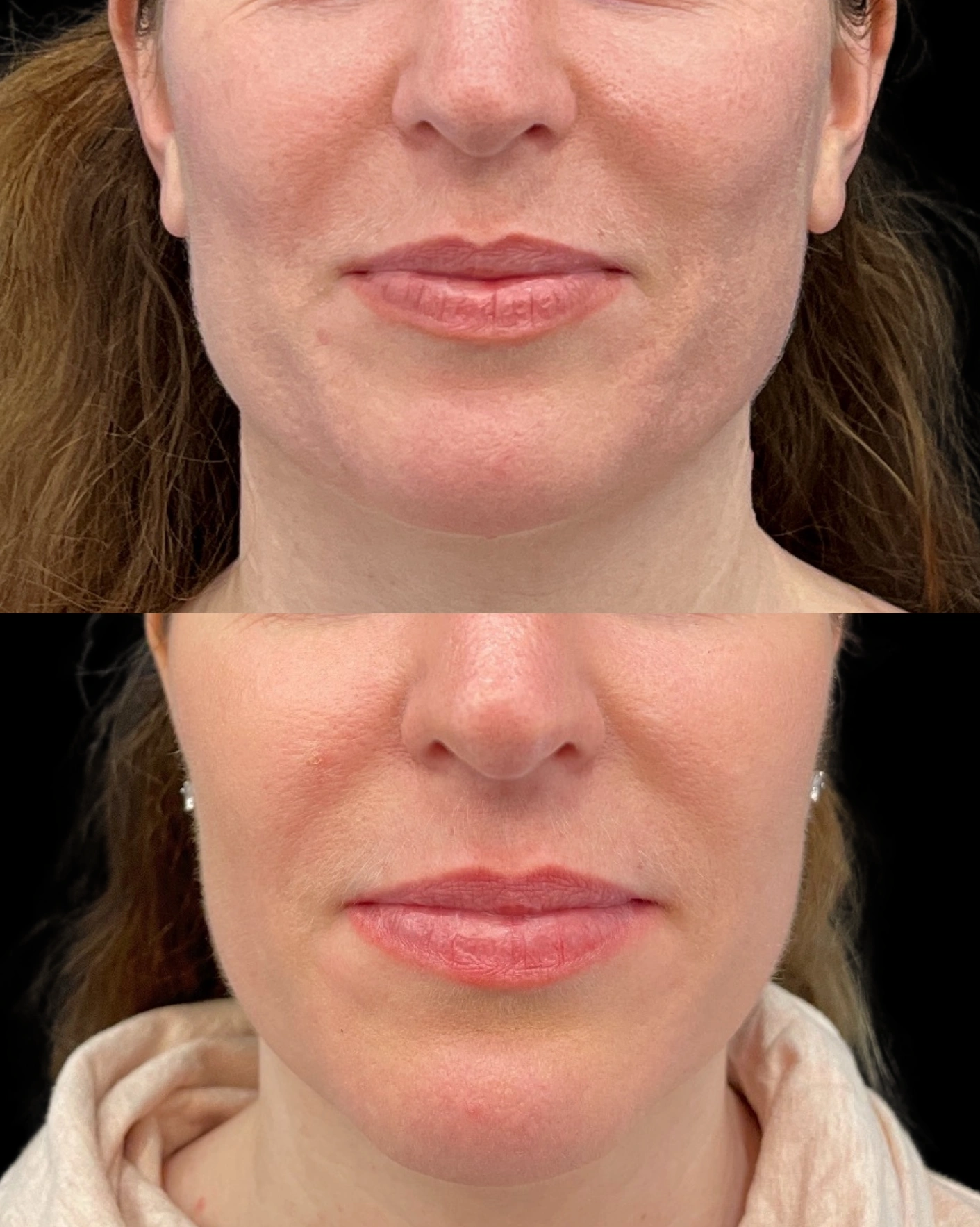 Real Patient Results by Motykie Med Spa serving Beverly Hills & Los Angeles, CA