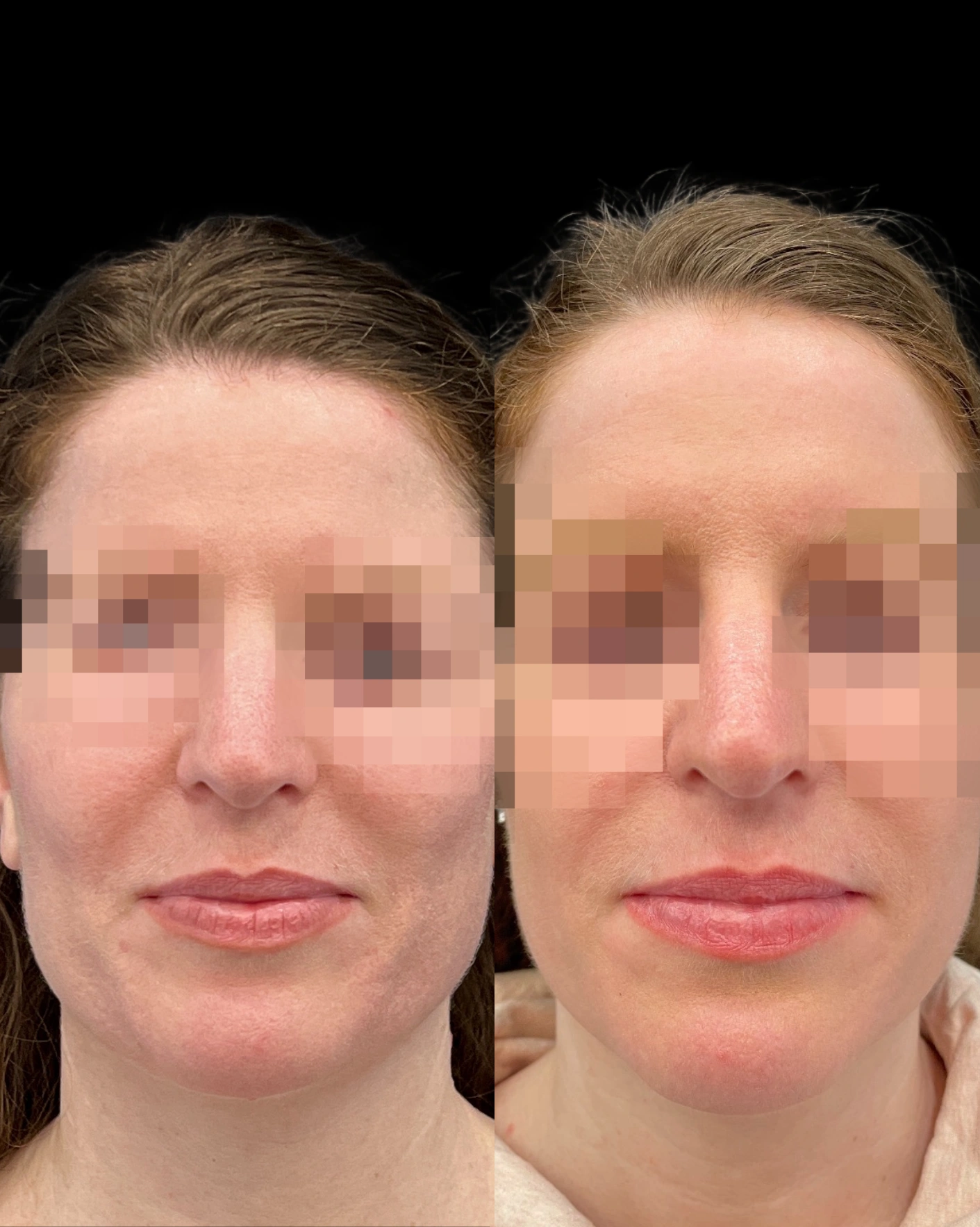 Real Patient Results by Motykie Med Spa serving Beverly Hills & Los Angeles, CA