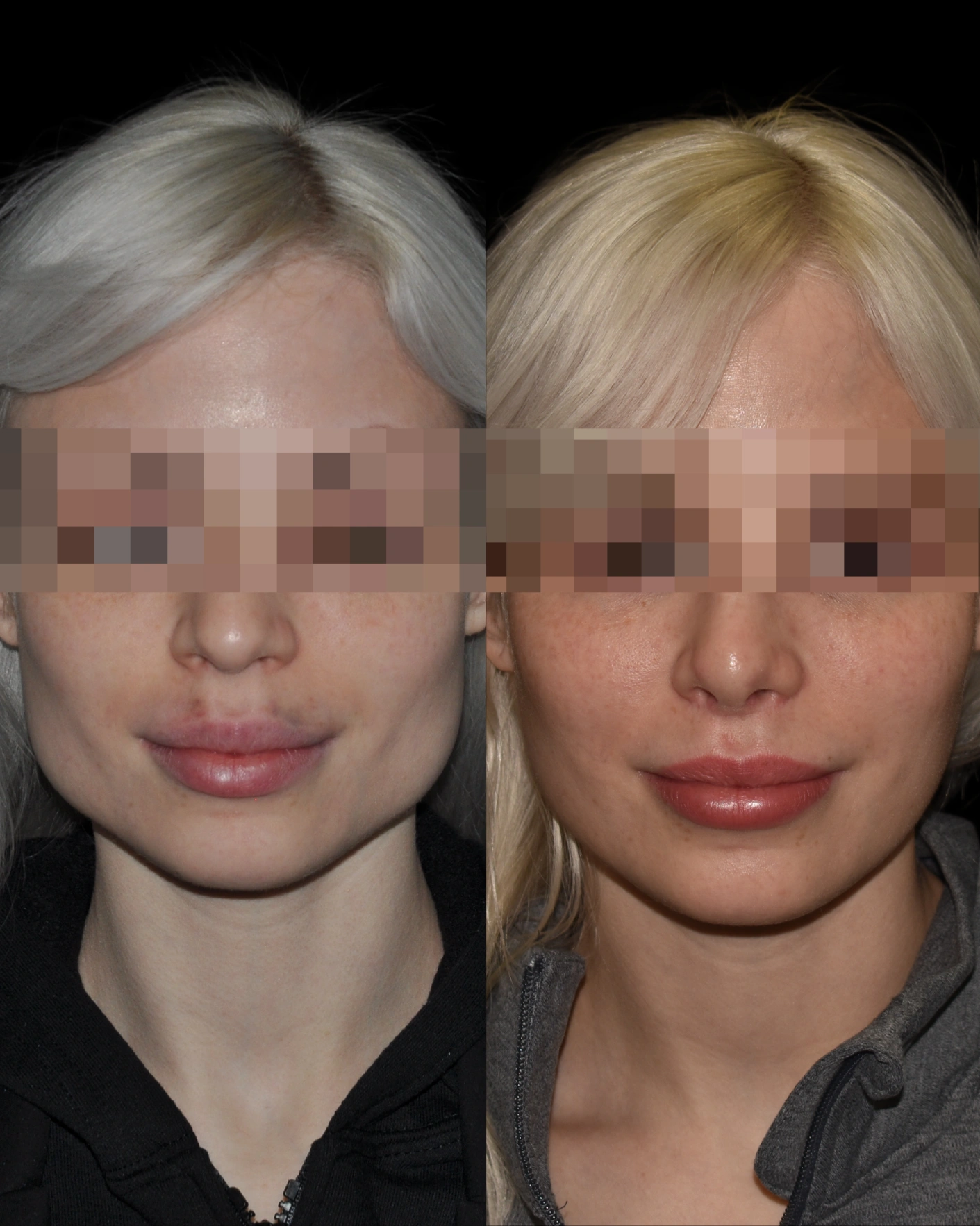 Real Patient Results by Motykie Med Spa serving Beverly Hills & Los Angeles, CA
