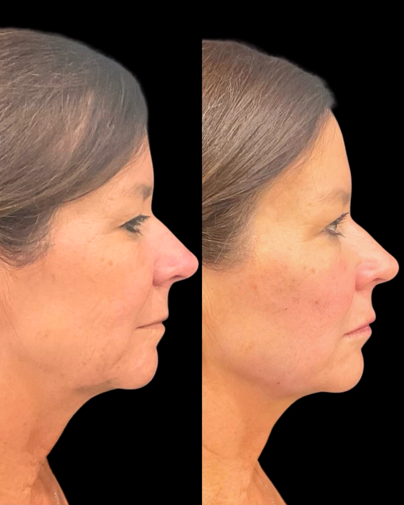Real Patient Results by Motykie Med Spa serving Beverly Hills & Los Angeles, CA