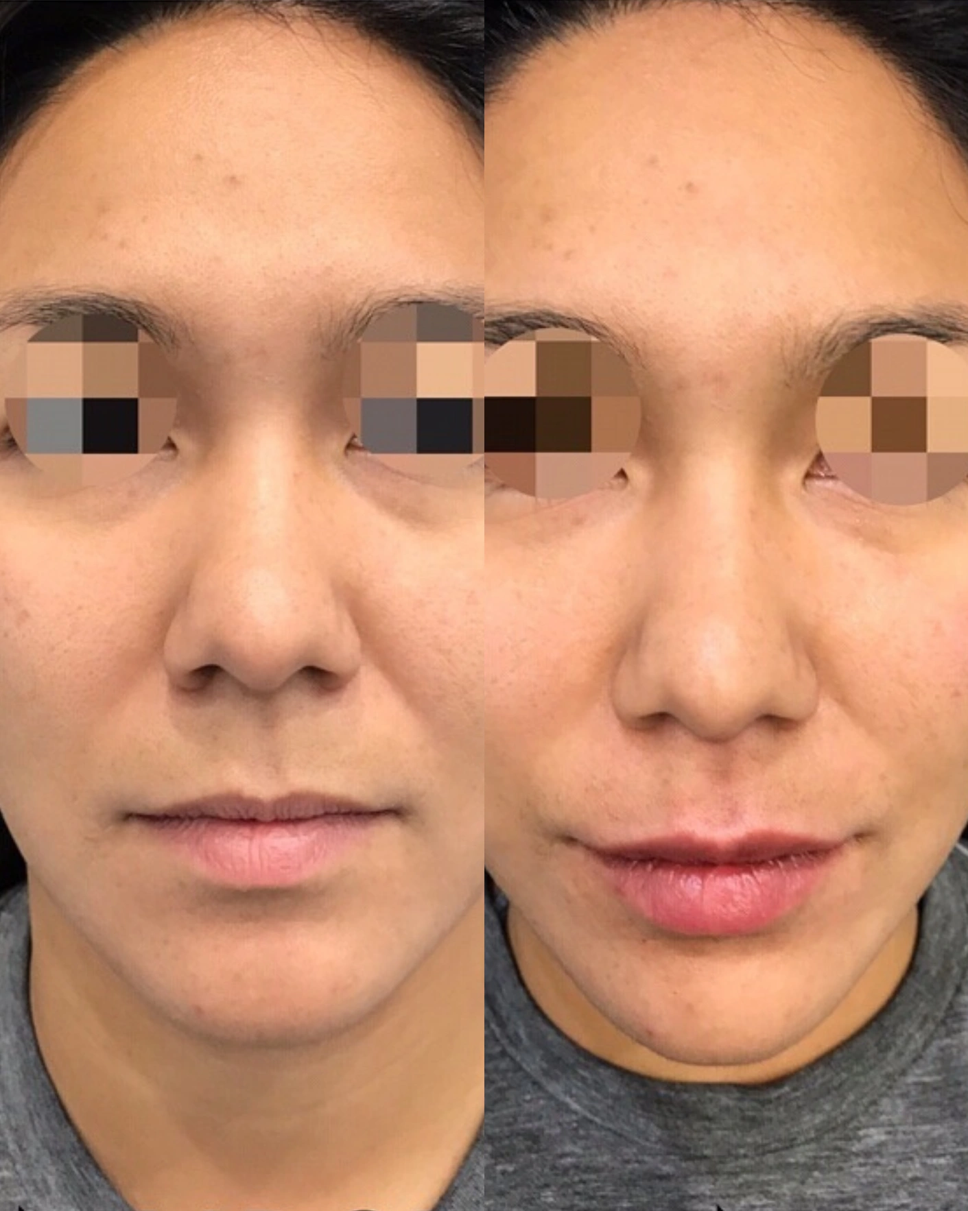 Real Patient Results by Motykie Med Spa serving Beverly Hills & Los Angeles, CA
