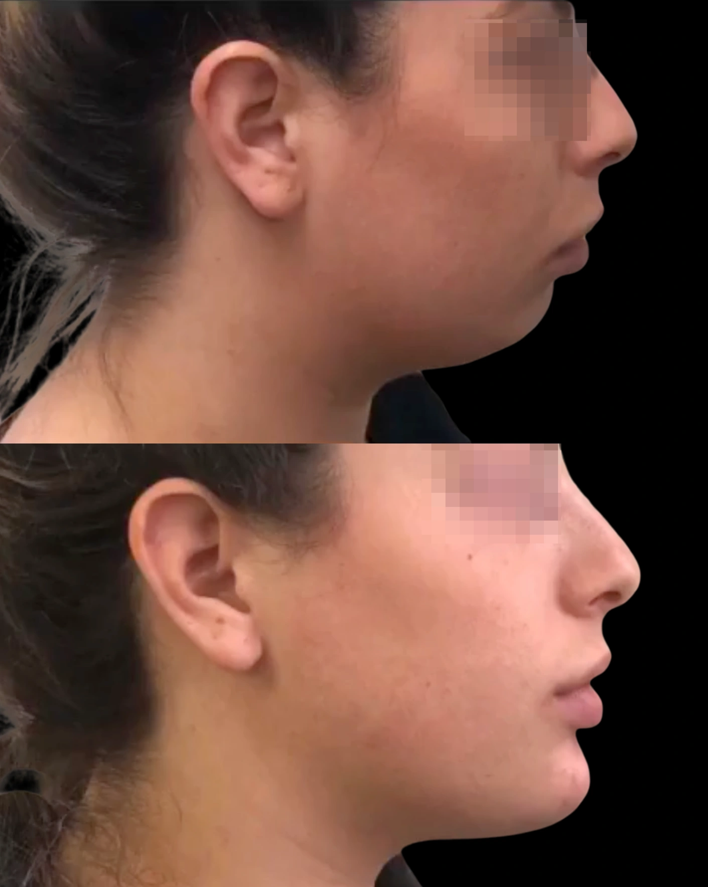 Real Patient Results by Motykie Med Spa serving Beverly Hills & Los Angeles, CA