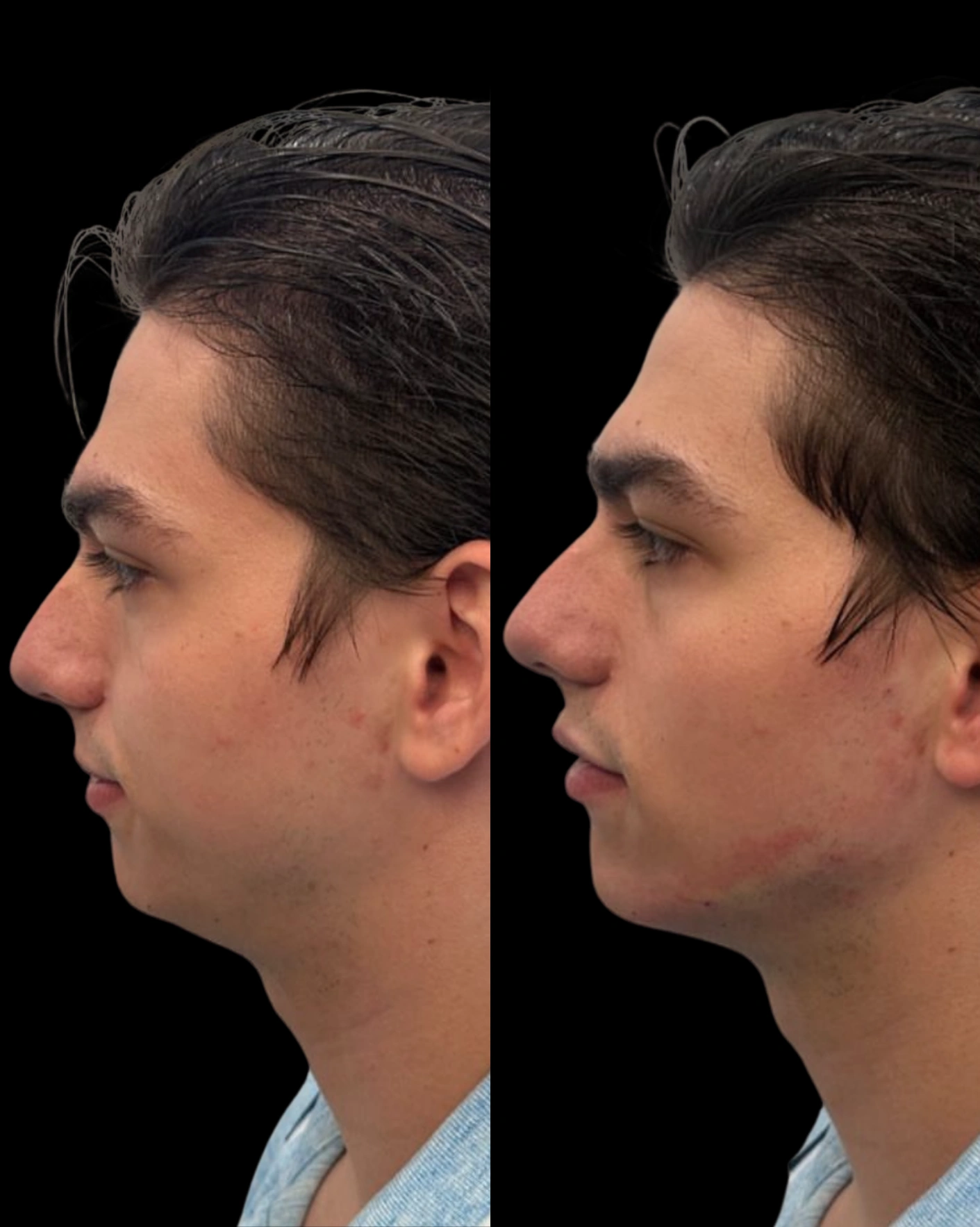 Real Patient Results by Motykie Med Spa serving Beverly Hills & Los Angeles, CA