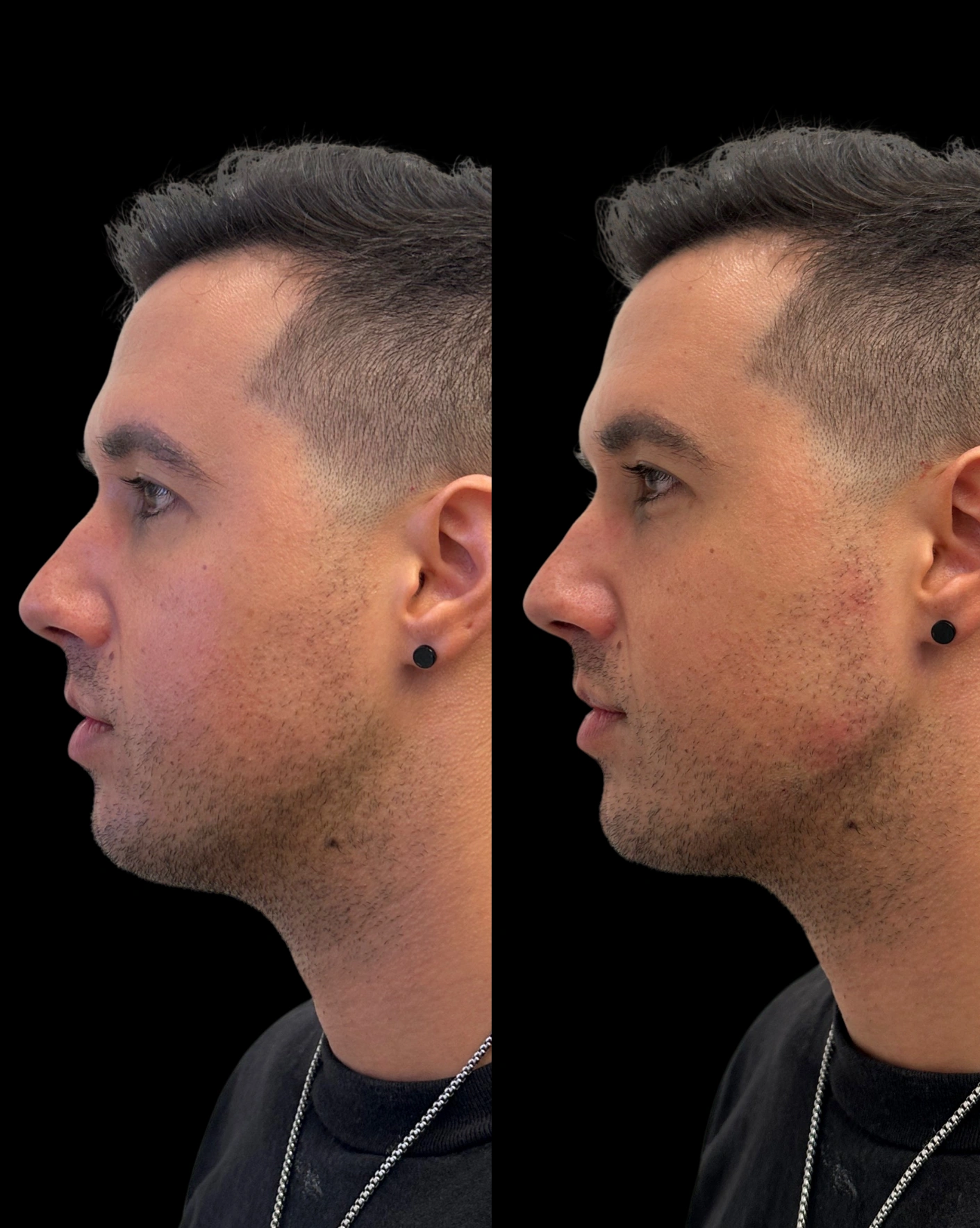 Real Patient Results by Motykie Med Spa serving Beverly Hills & Los Angeles, CA