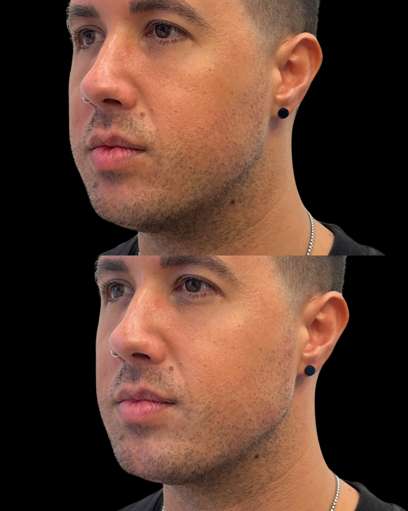 Real Patient Results by Motykie Med Spa serving Beverly Hills & Los Angeles, CA