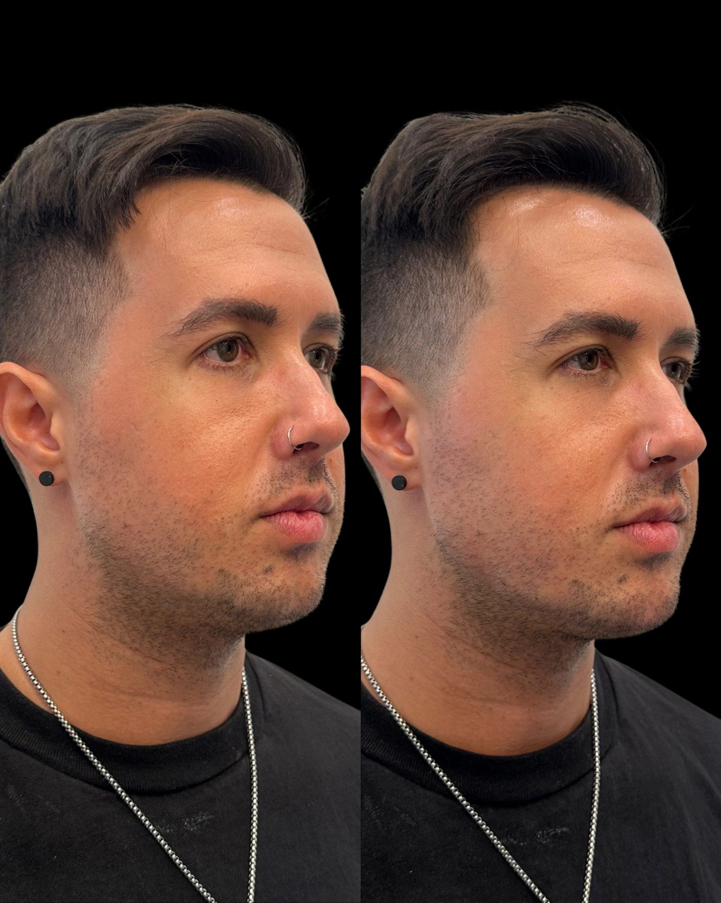 Real Patient Results by Motykie Med Spa serving Beverly Hills & Los Angeles, CA