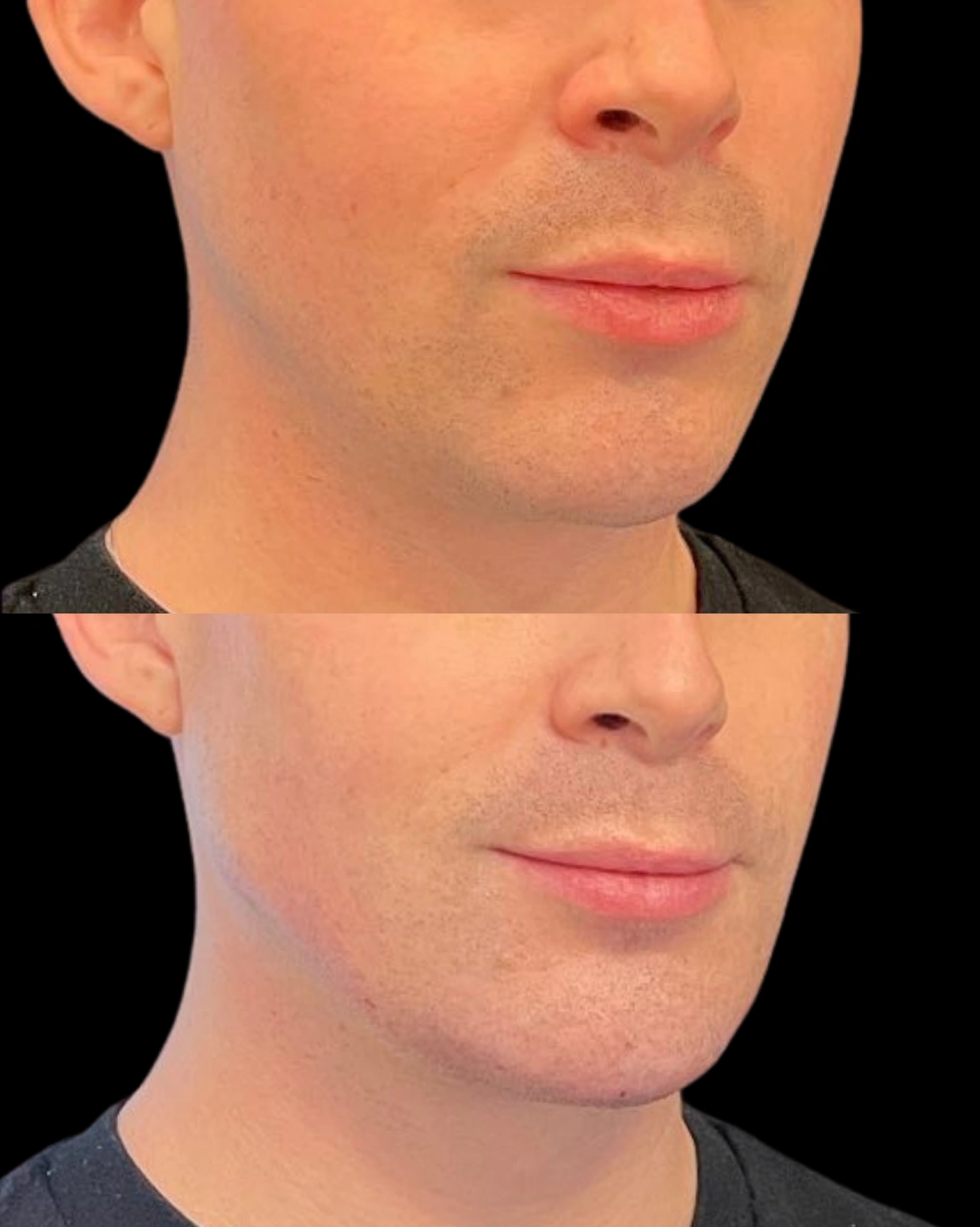 Real Patient Results by Motykie Med Spa serving Beverly Hills & Los Angeles, CA