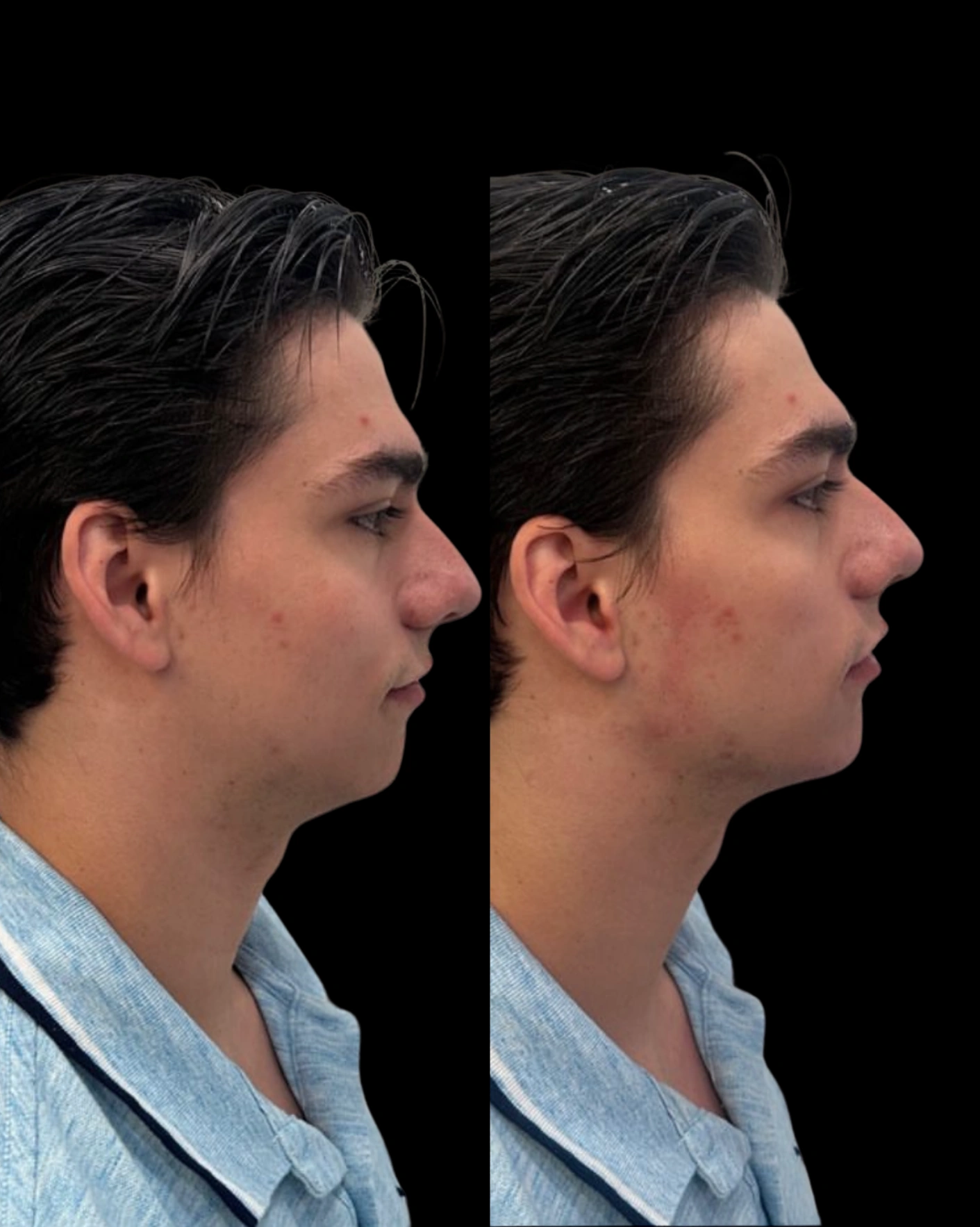 Real Patient Results by Motykie Med Spa serving Beverly Hills & Los Angeles, CA