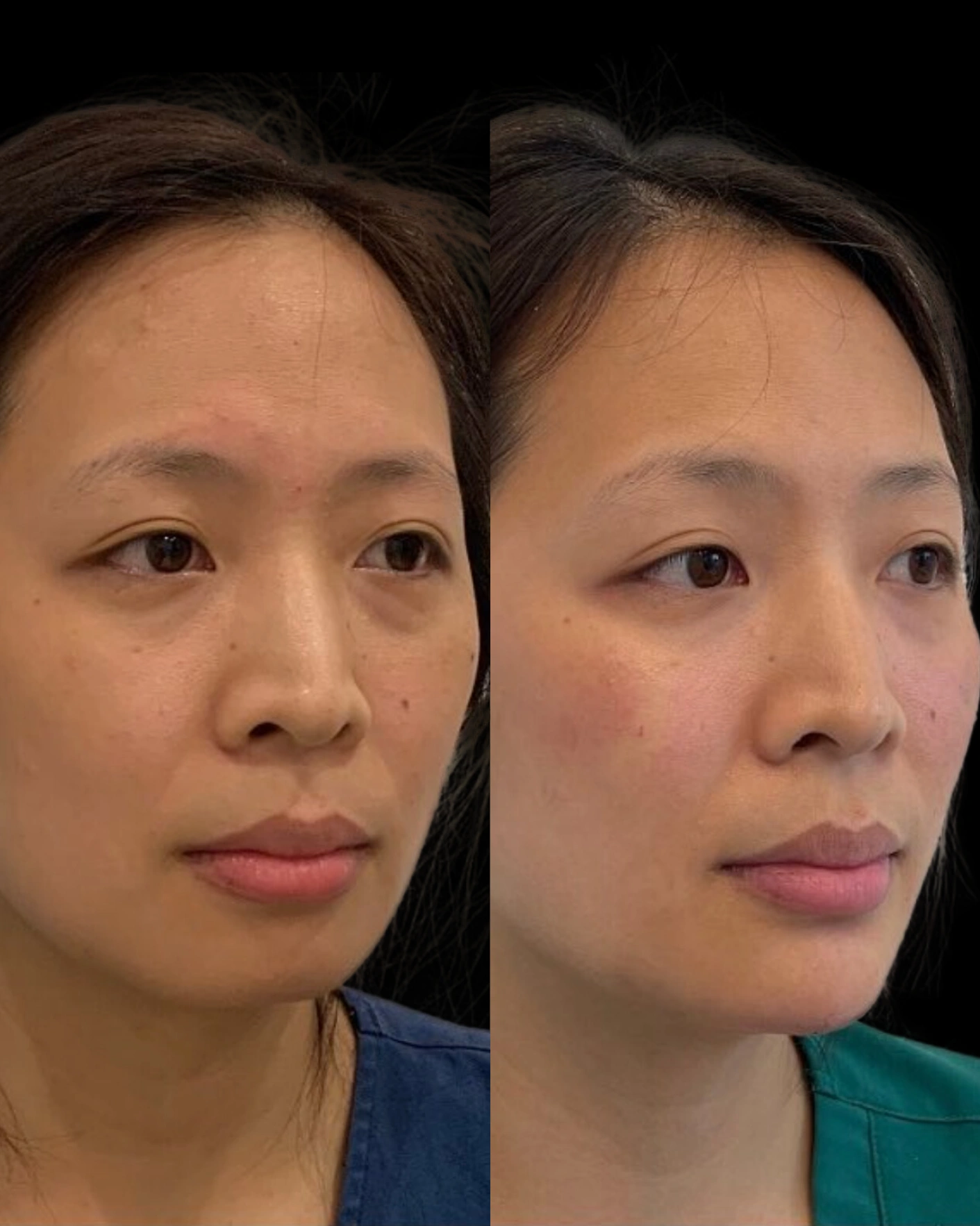 Real Patient Results by Motykie Med Spa serving Beverly Hills & Los Angeles, CA