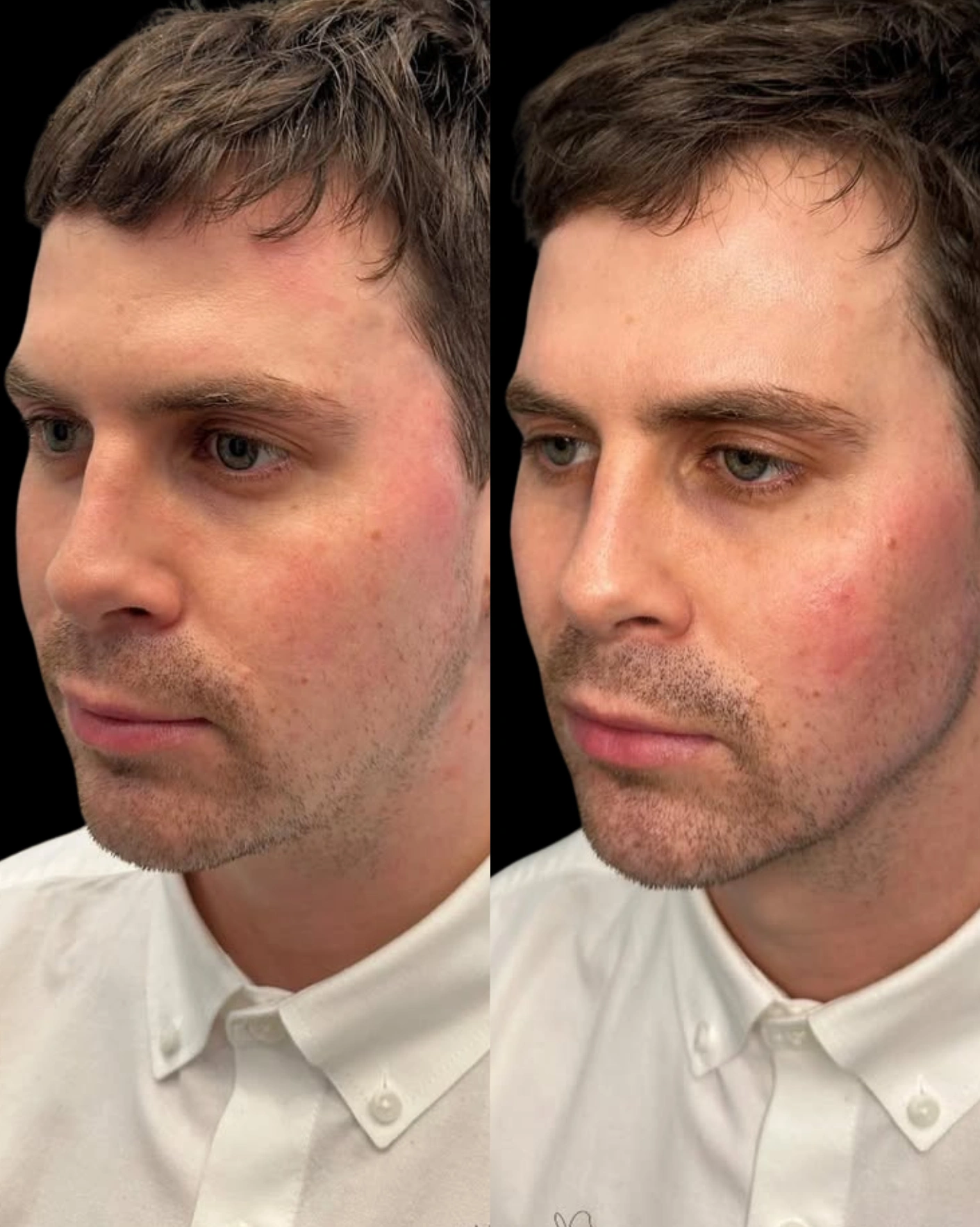 Real Patient Results by Motykie Med Spa serving Beverly Hills & Los Angeles, CA