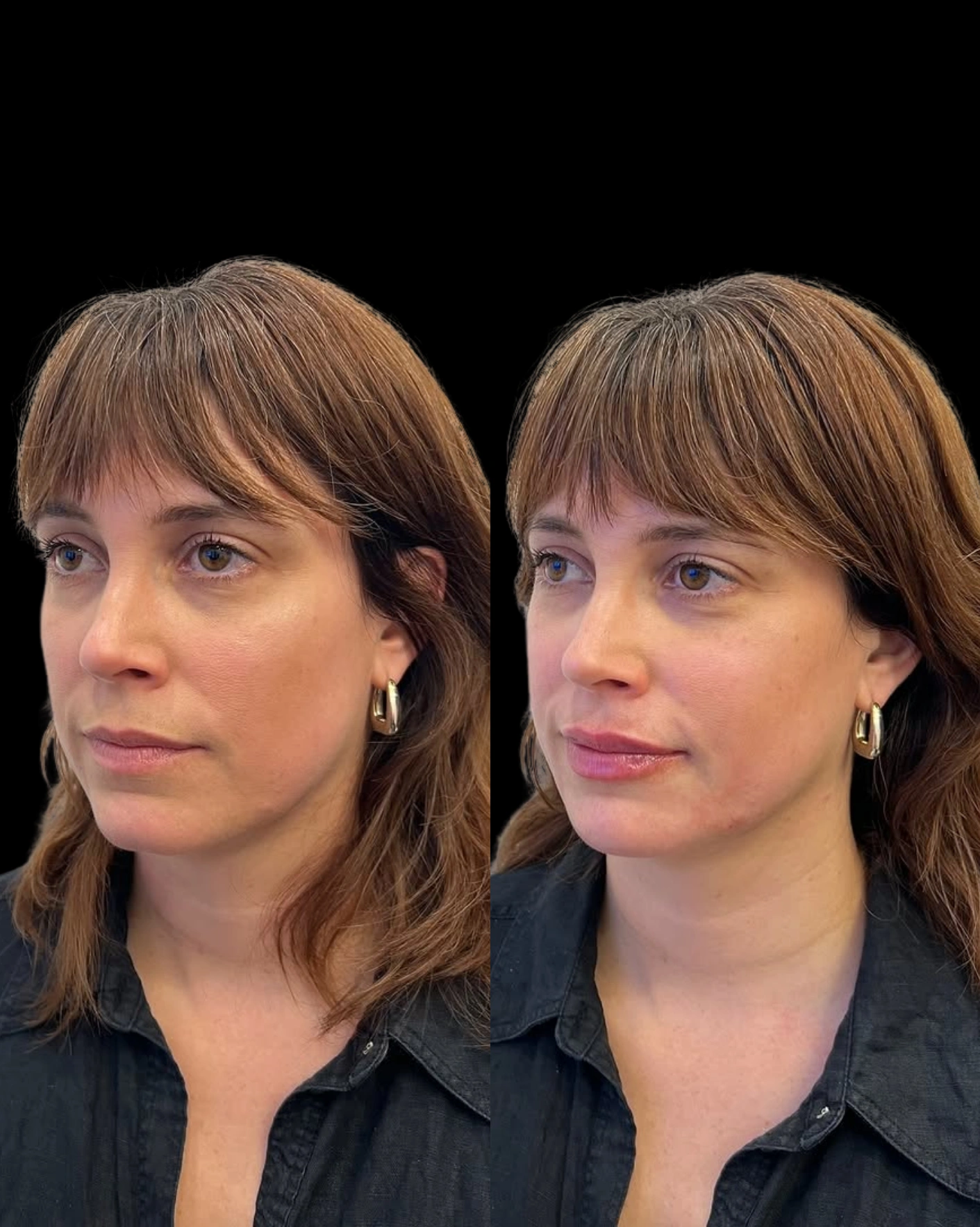 Real Patient Results by Motykie Med Spa serving Beverly Hills & Los Angeles, CA