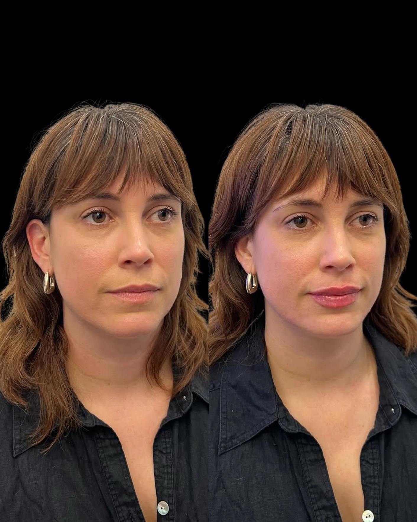 Real Patient Results by Motykie Med Spa serving Beverly Hills & Los Angeles, CA