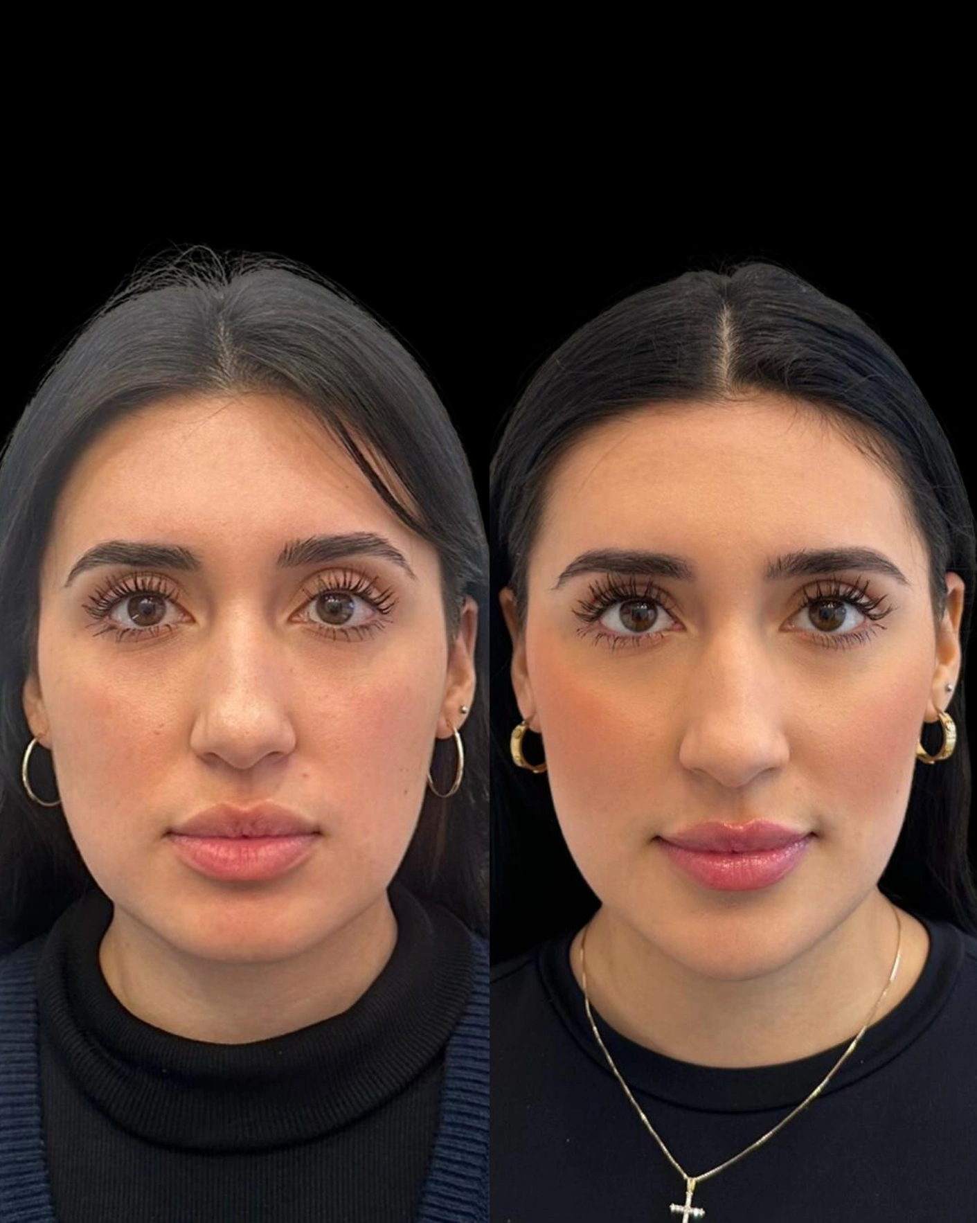 Real Patient Results by Motykie Med Spa serving Beverly Hills & Los Angeles, CA