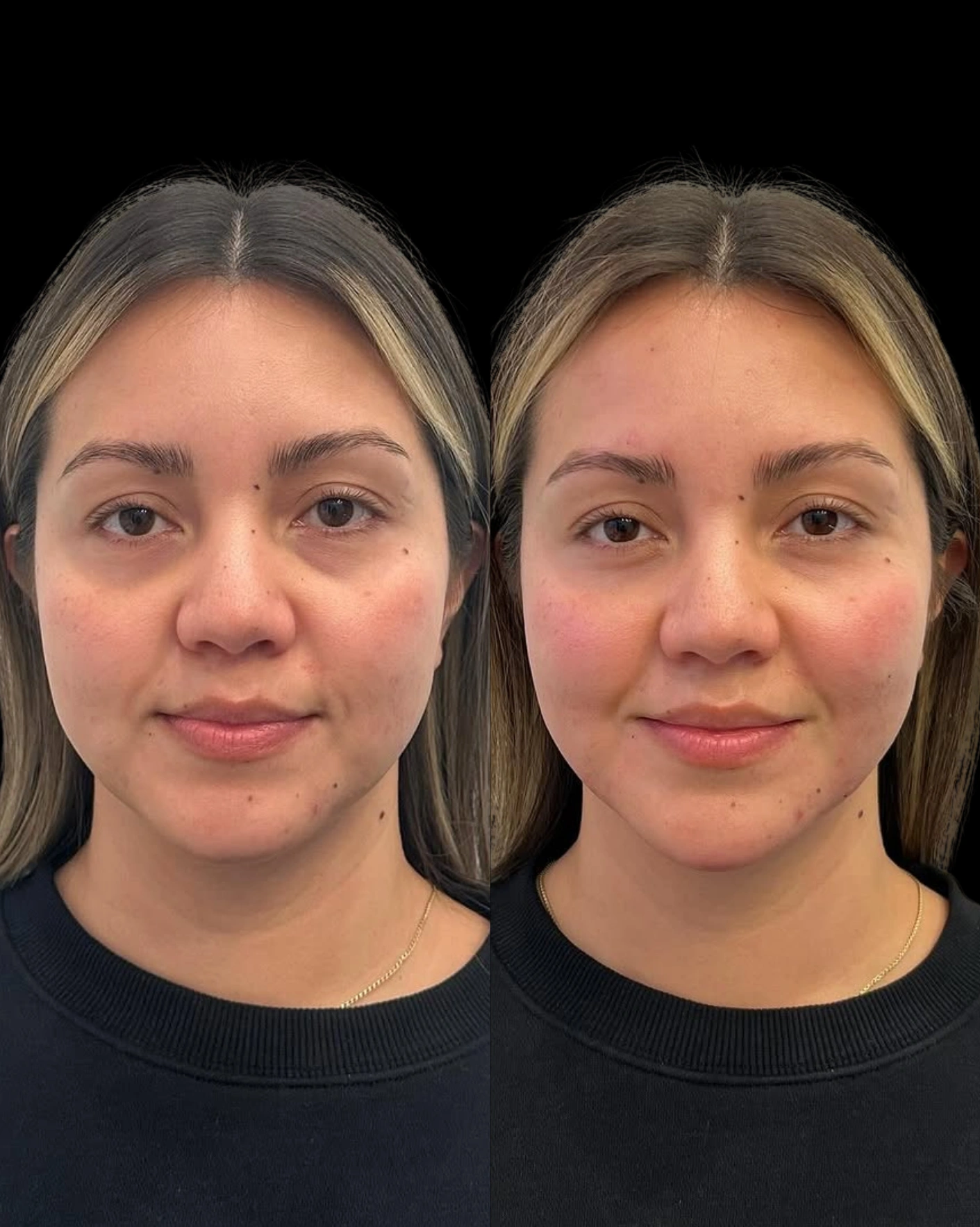 Real Patient Results by Motykie Med Spa serving Beverly Hills & Los Angeles, CA
