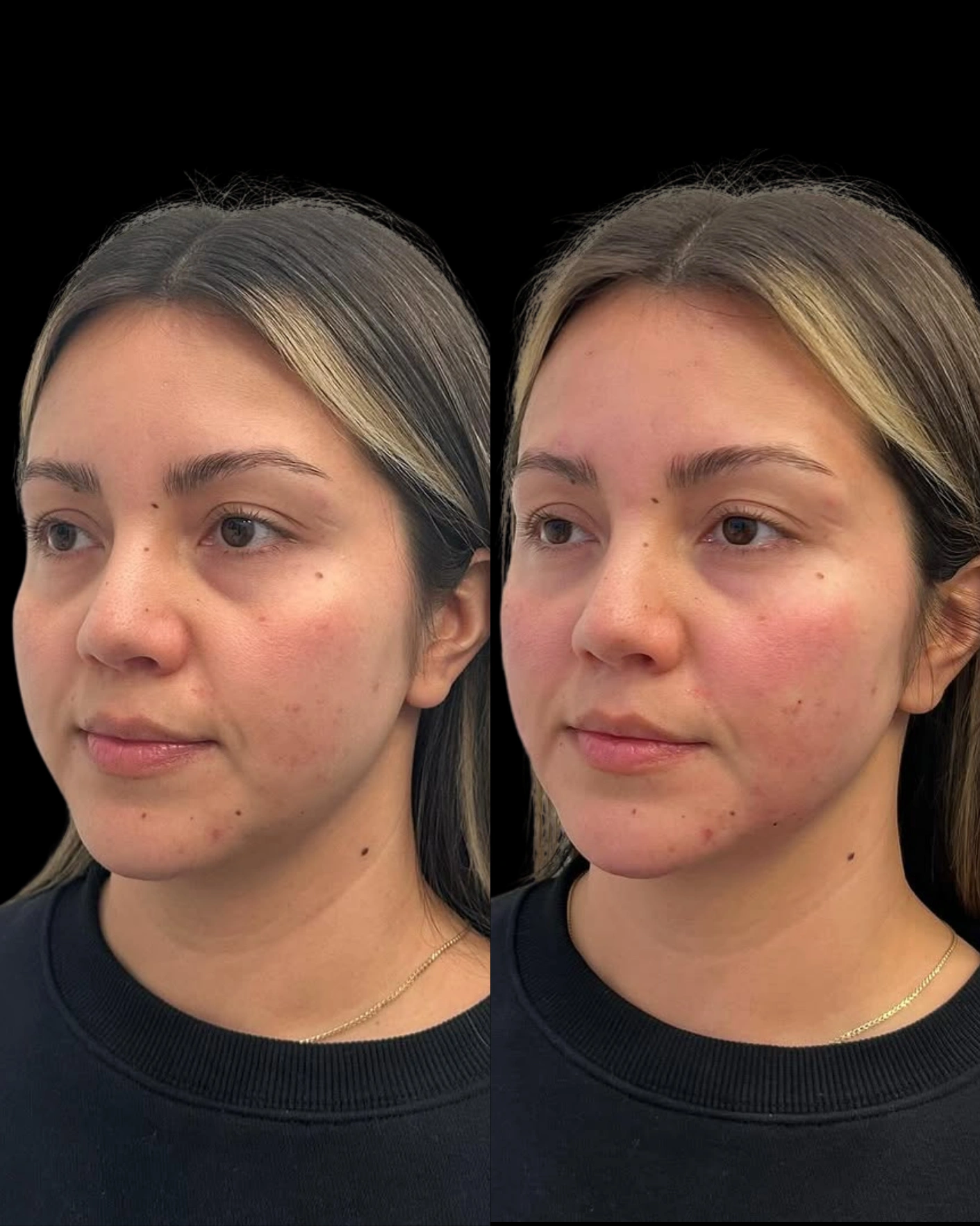 Real Patient Results by Motykie Med Spa serving Beverly Hills & Los Angeles, CA