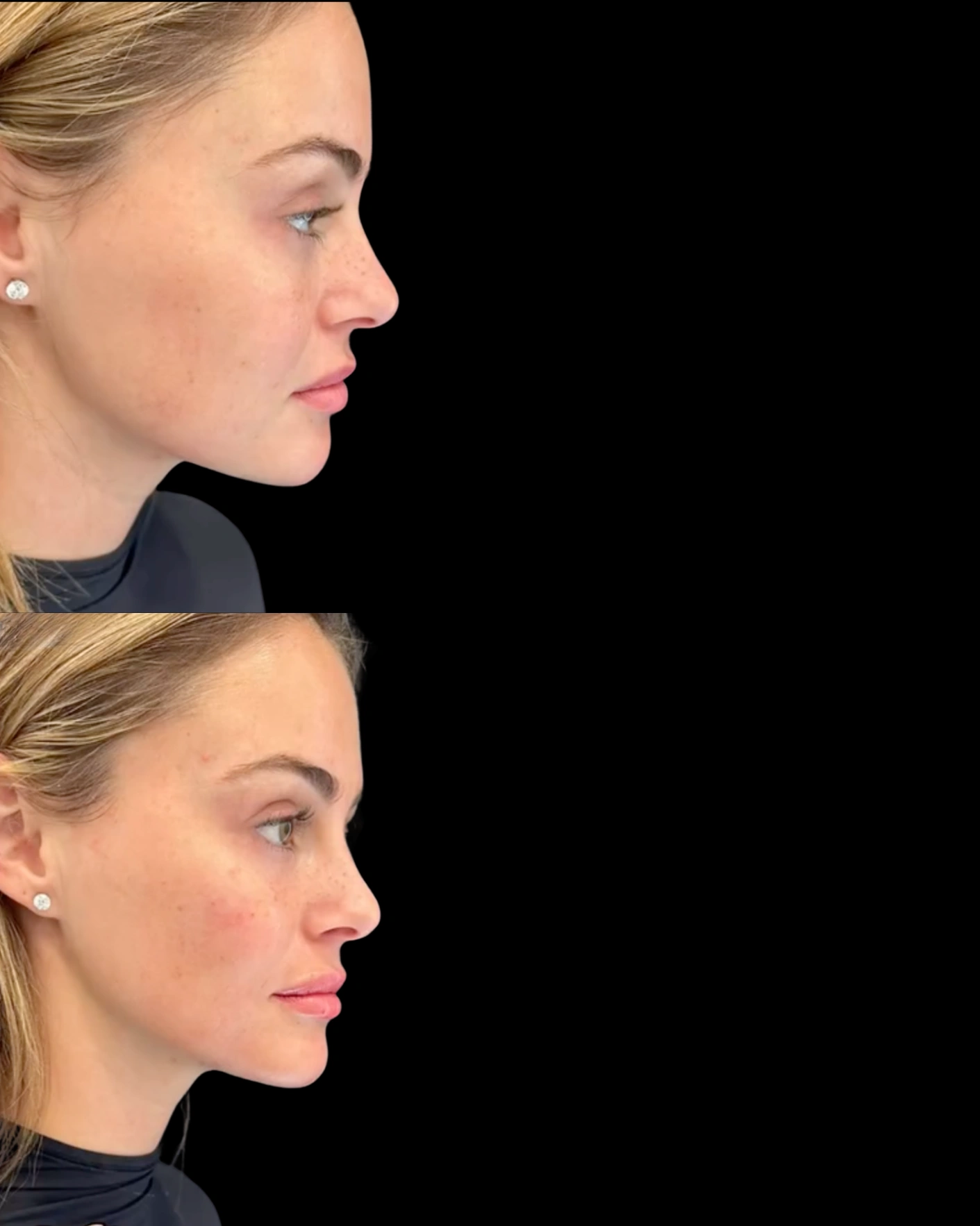 Real Patient Results by Motykie Med Spa serving Beverly Hills & Los Angeles, CA