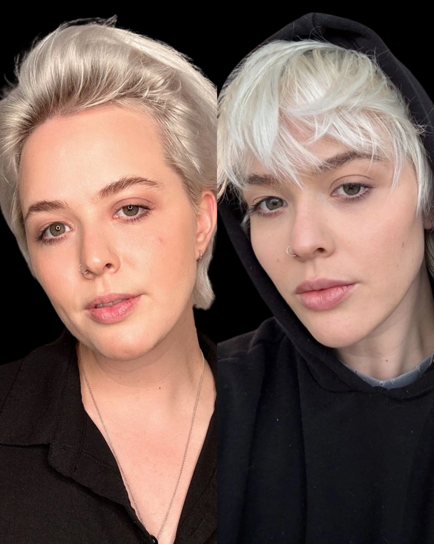 Real Patient Results by Motykie Med Spa serving Beverly Hills & Los Angeles, CA