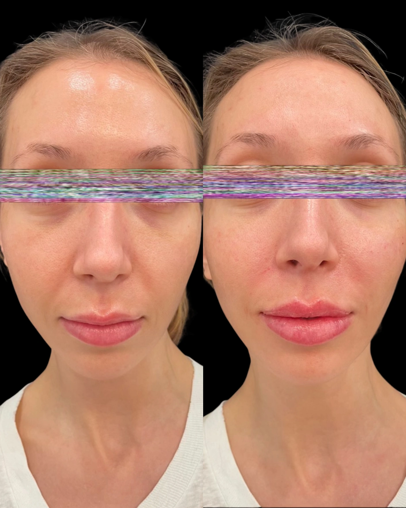 Real Patient Results by Motykie Med Spa serving Beverly Hills & Los Angeles, CA