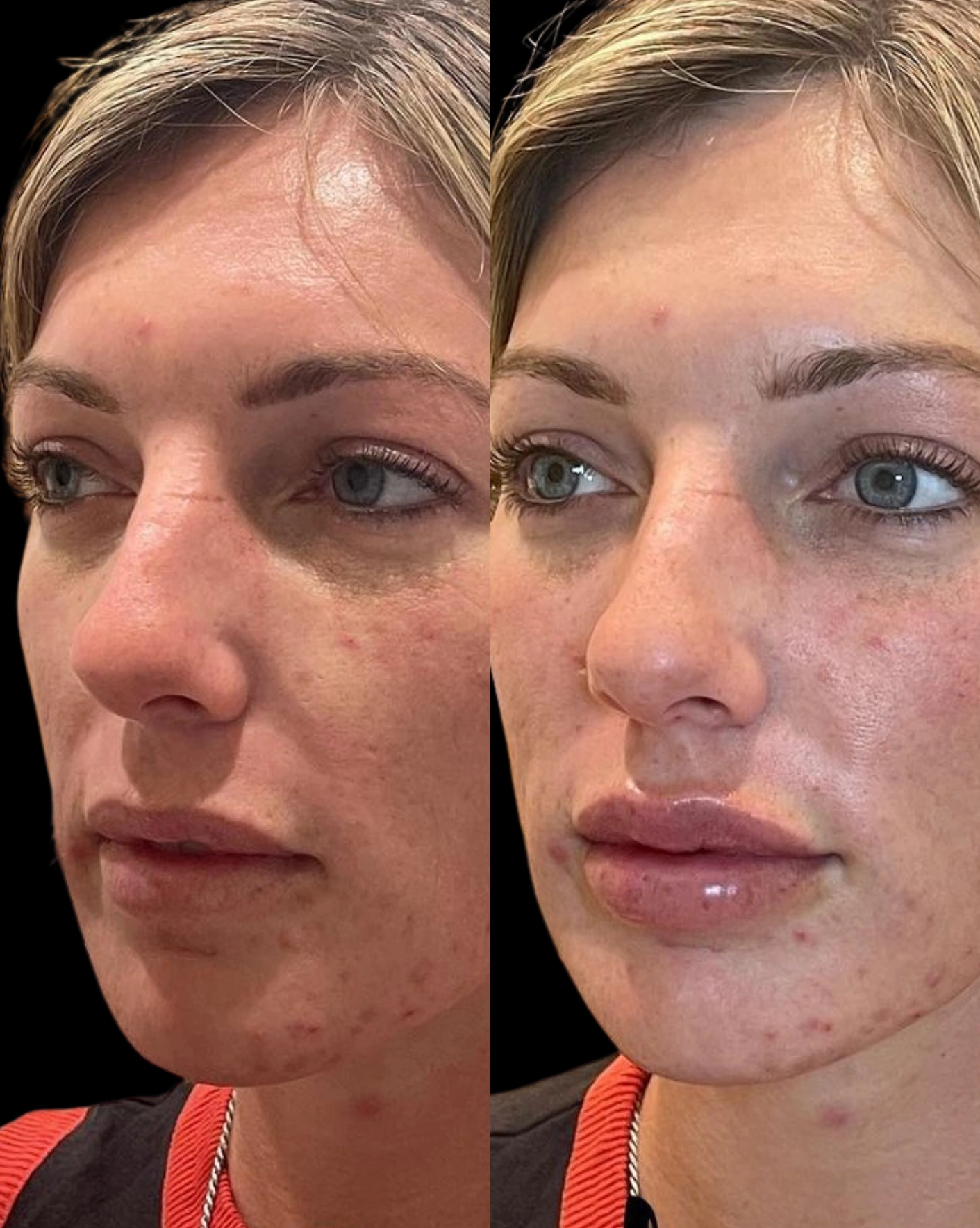 Real Patient Results by Motykie Med Spa serving Beverly Hills & Los Angeles, CA