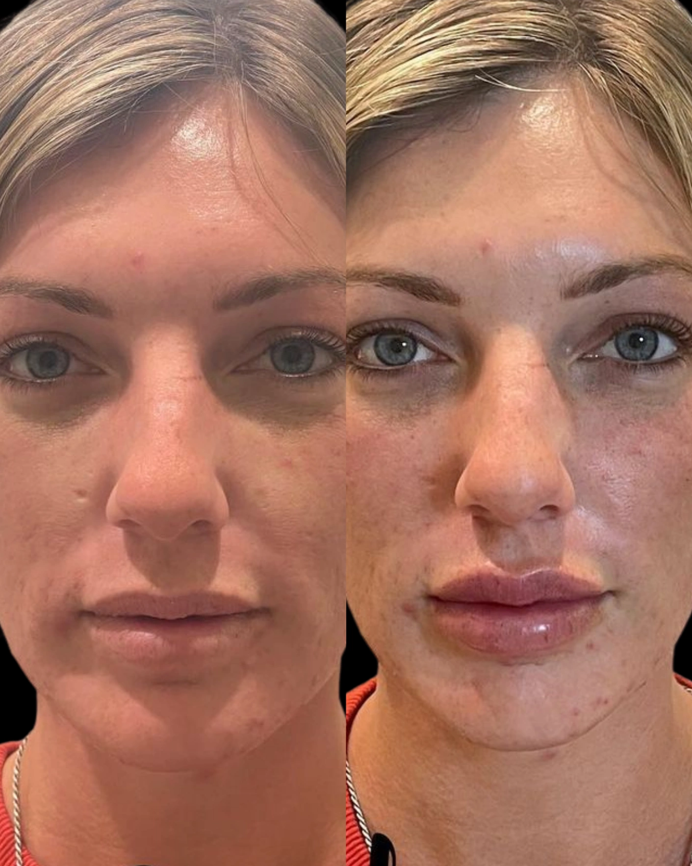 Real Patient Results by Motykie Med Spa serving Beverly Hills & Los Angeles, CA