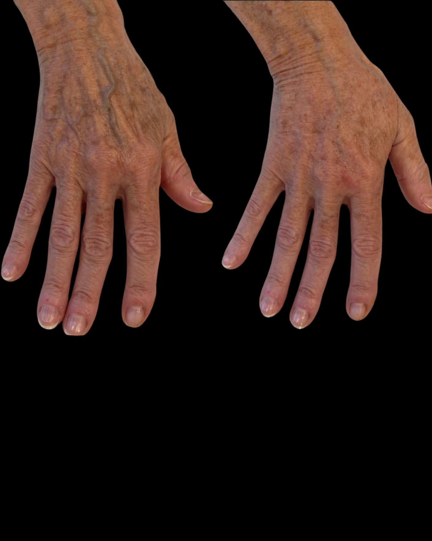 Real Patient Results by Motykie Med Spa serving Beverly Hills & Los Angeles, CA