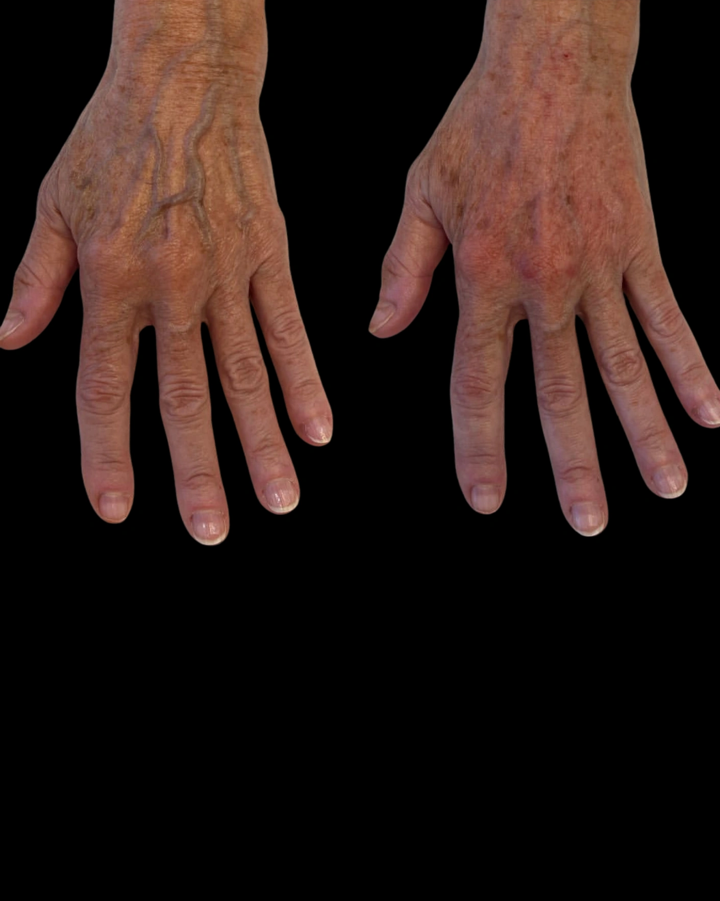 Real Patient Results by Motykie Med Spa serving Beverly Hills & Los Angeles, CA