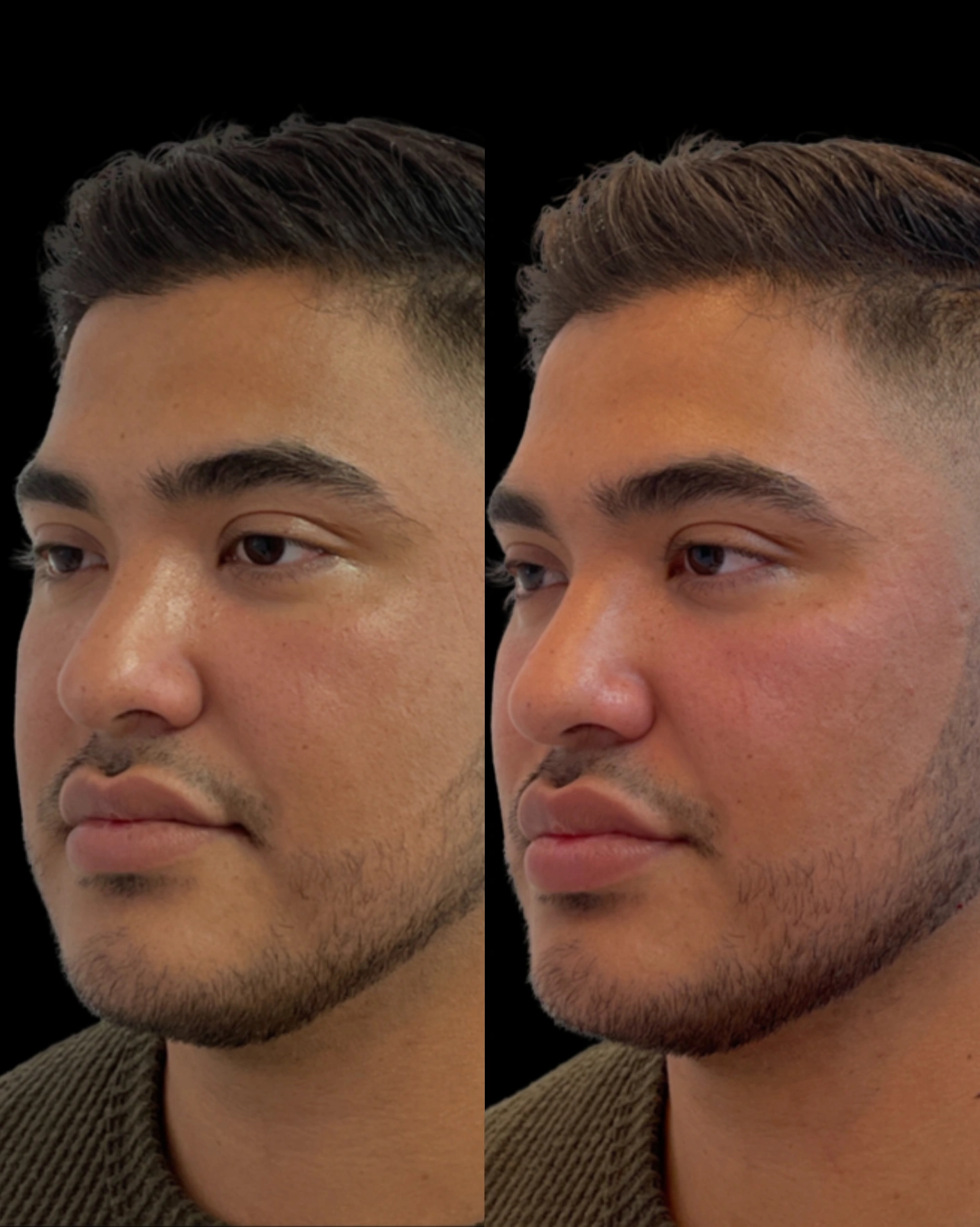 Real Patient Results by Motykie Med Spa serving Beverly Hills & Los Angeles, CA