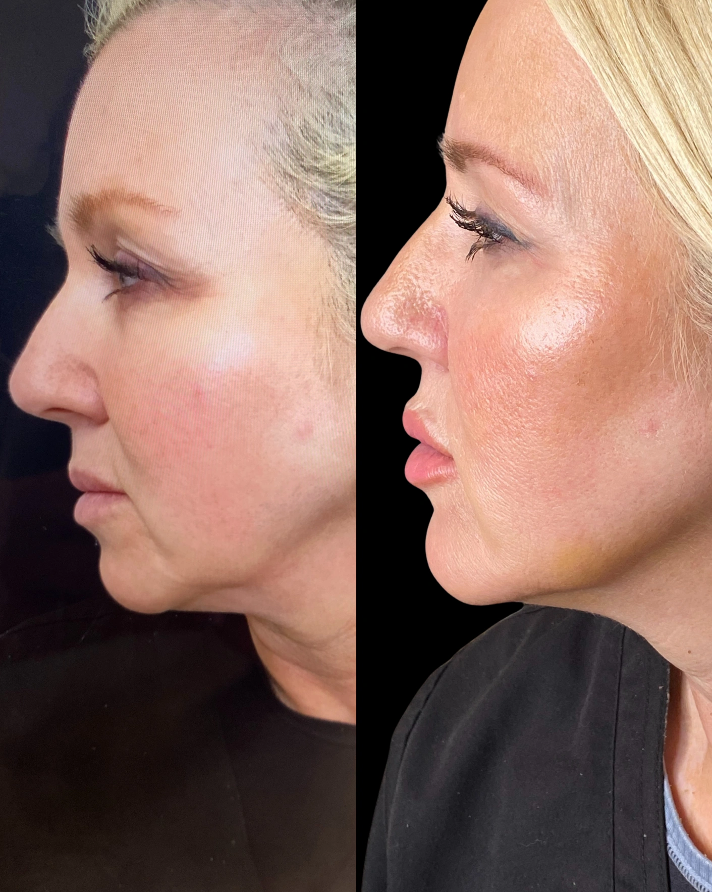Real Patient Results by Motykie Med Spa serving Beverly Hills & Los Angeles, CA