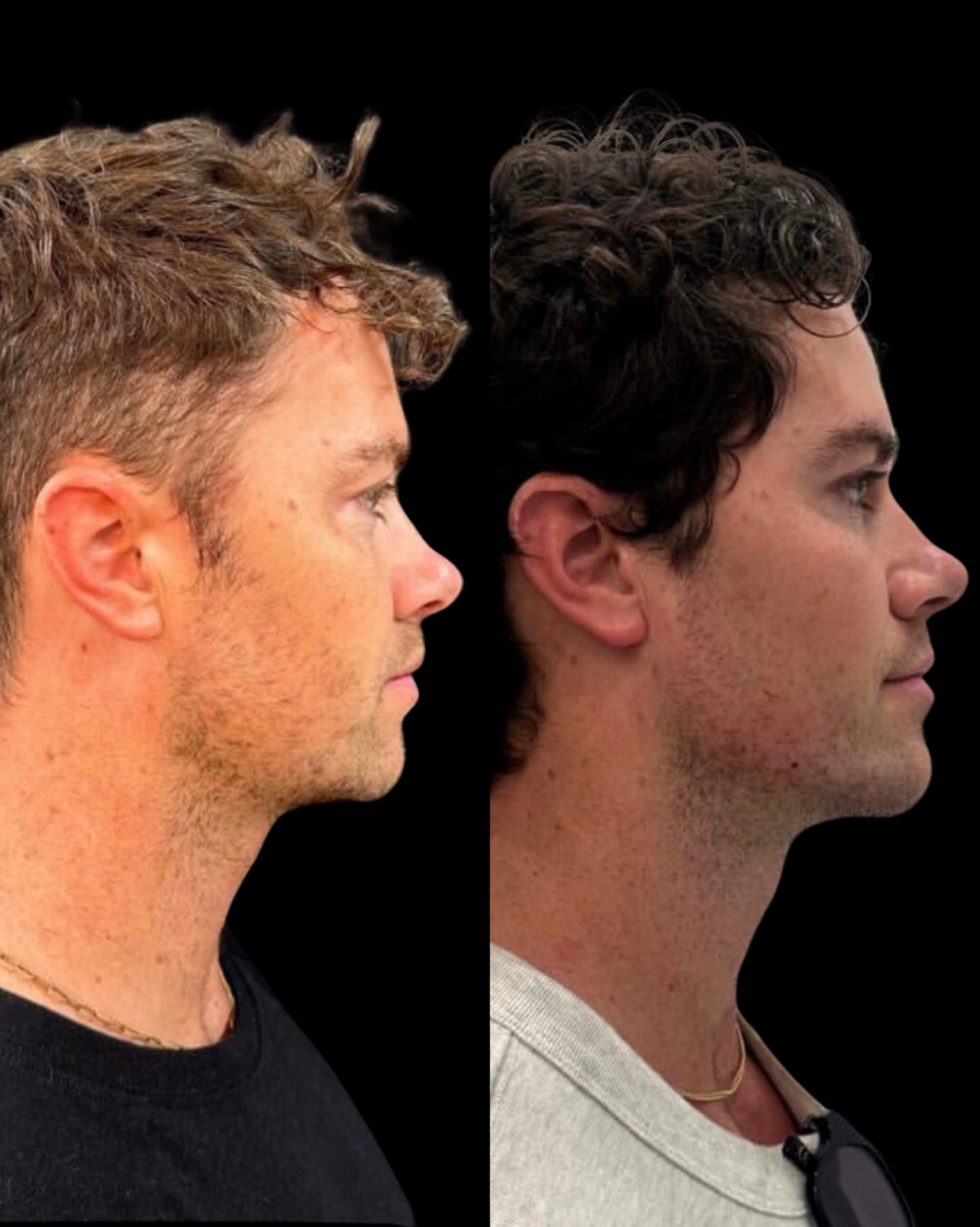 Real Patient Results by Motykie Med Spa serving Beverly Hills & Los Angeles, CA