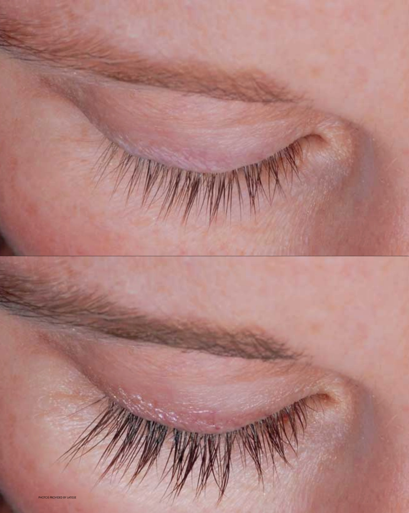 Real Patient Results by Motykie Med Spa serving Beverly Hills & Los Angeles, CA