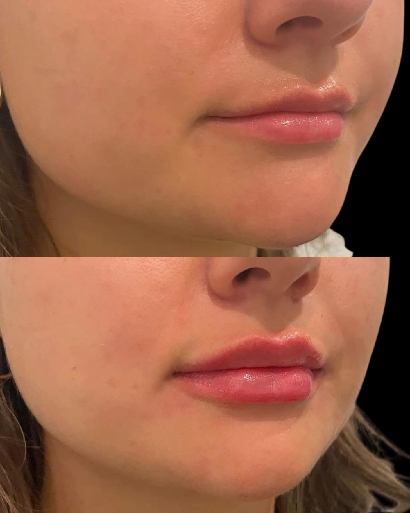 Real Patient Results by Motykie Med Spa serving Beverly Hills & Los Angeles, CA