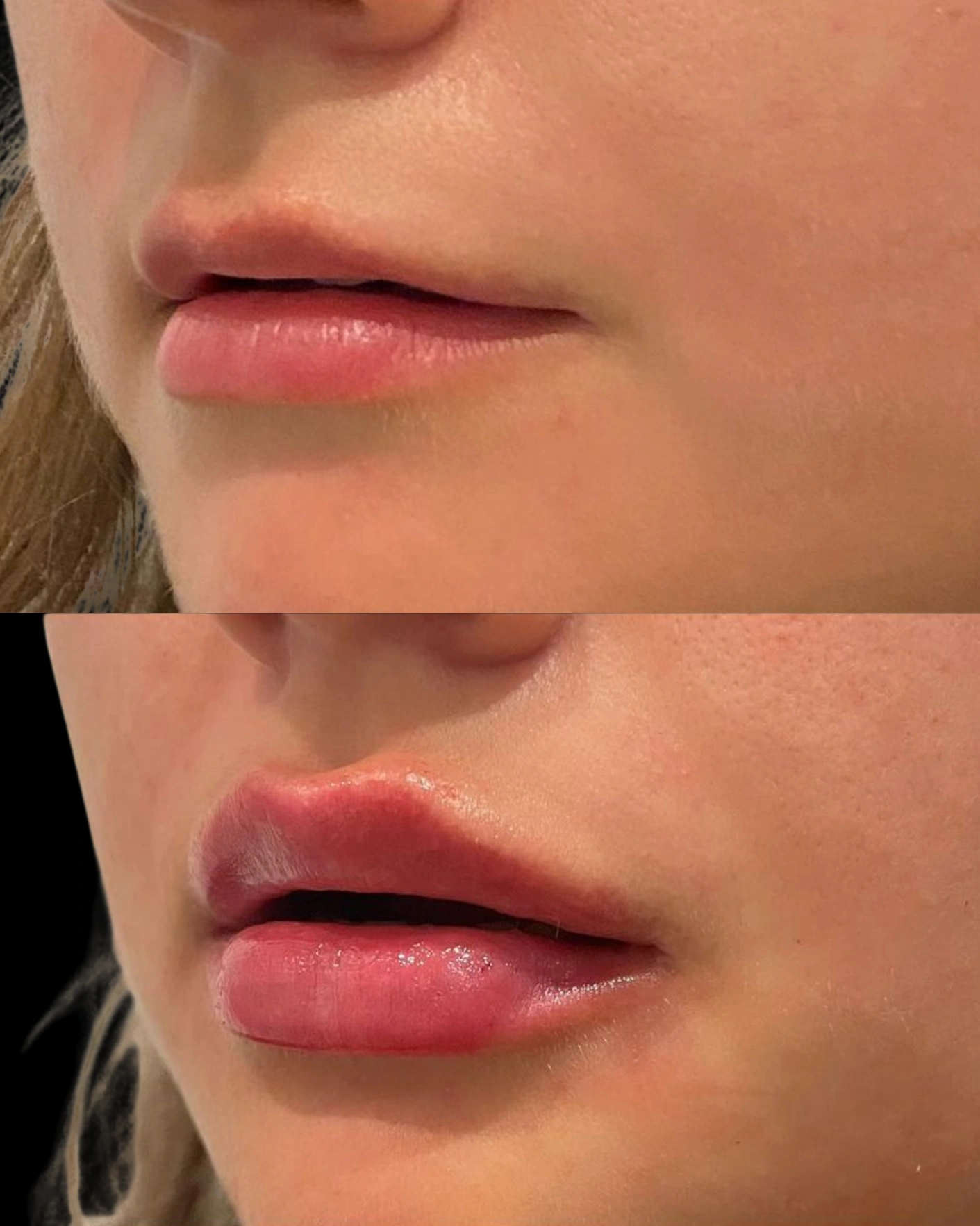 Real Patient Results by Motykie Med Spa serving Beverly Hills & Los Angeles, CA