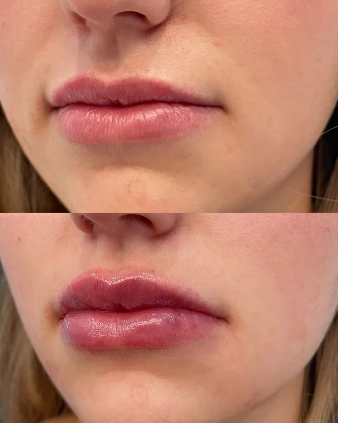 Real Patient Results by Motykie Med Spa serving Beverly Hills & Los Angeles, CA