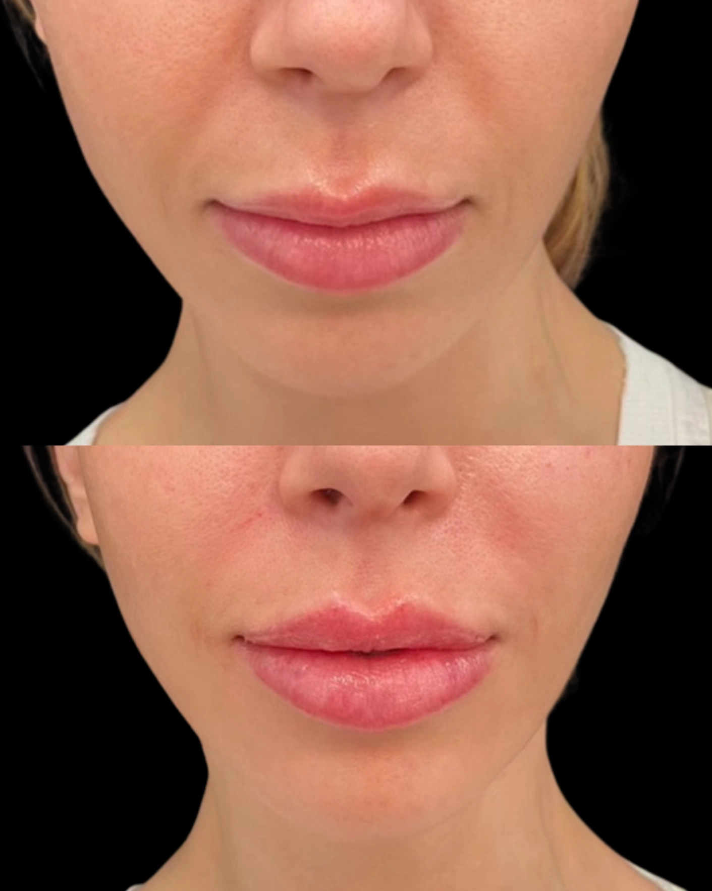 Real Patient Results by Motykie Med Spa serving Beverly Hills & Los Angeles, CA