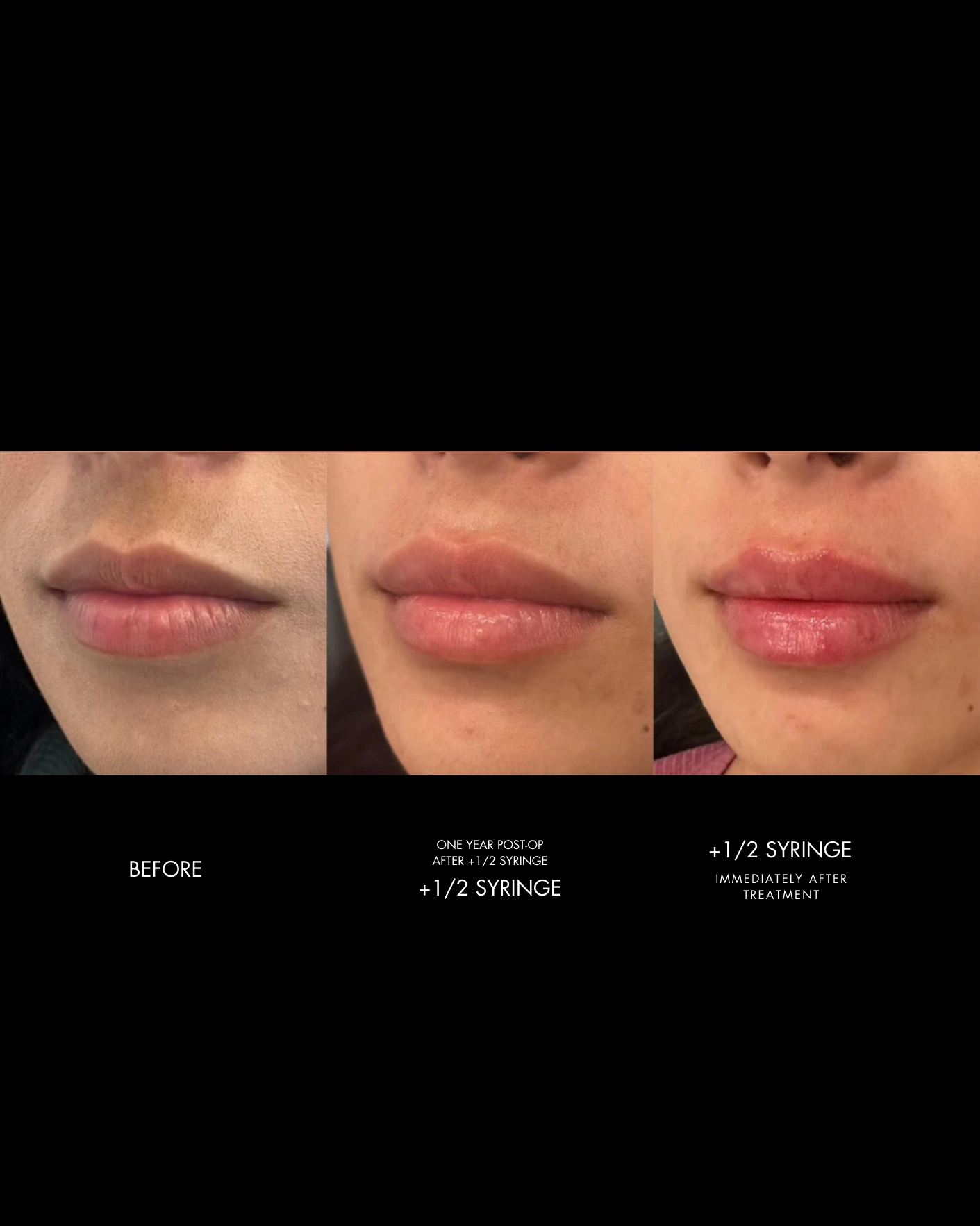 Real Patient Results by Motykie Med Spa serving Beverly Hills & Los Angeles, CA