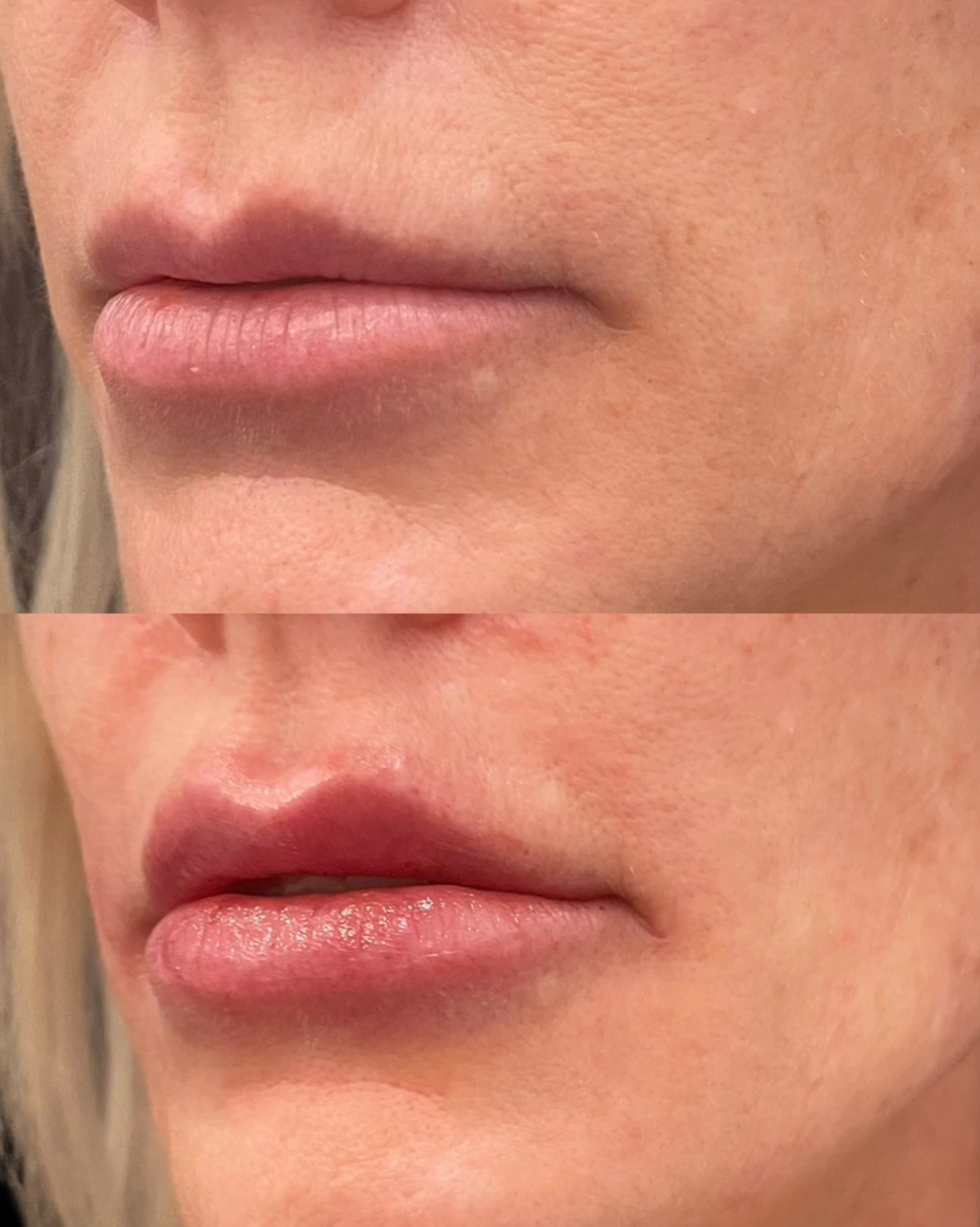 Real Patient Results by Motykie Med Spa serving Beverly Hills & Los Angeles, CA