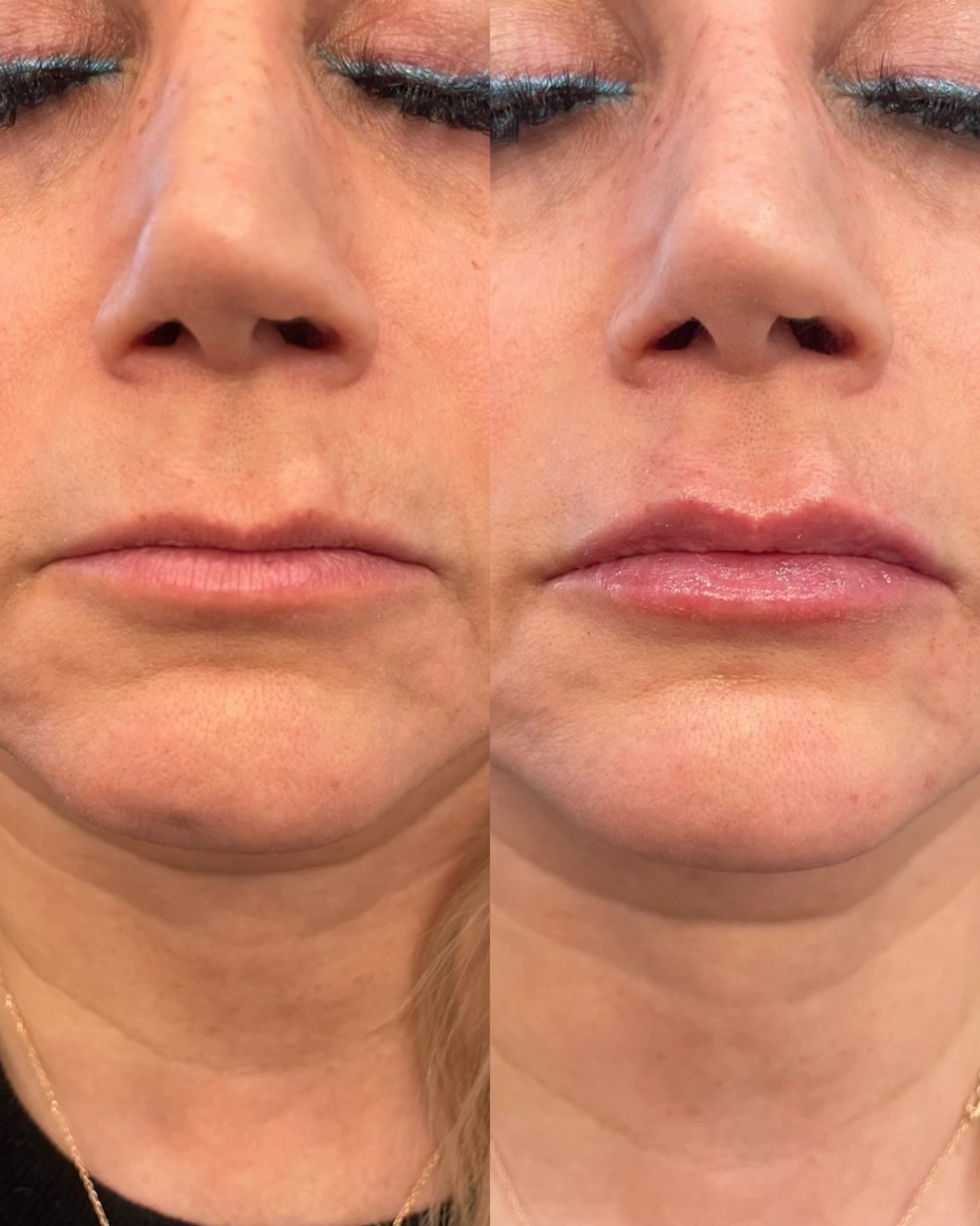Real Patient Results by Motykie Med Spa serving Beverly Hills & Los Angeles, CA