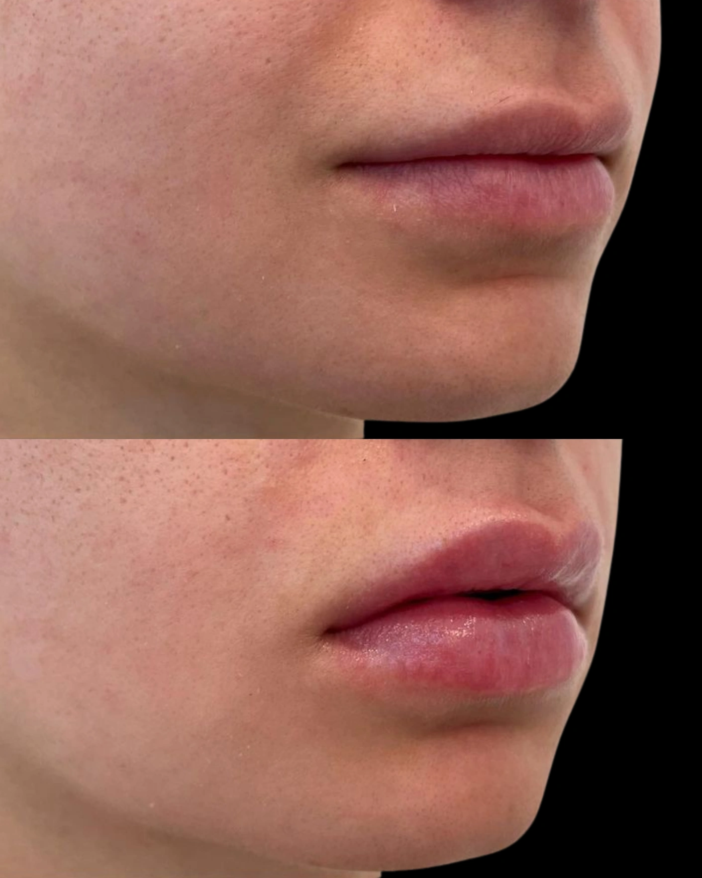 Real Patient Results by Motykie Med Spa serving Beverly Hills & Los Angeles, CA