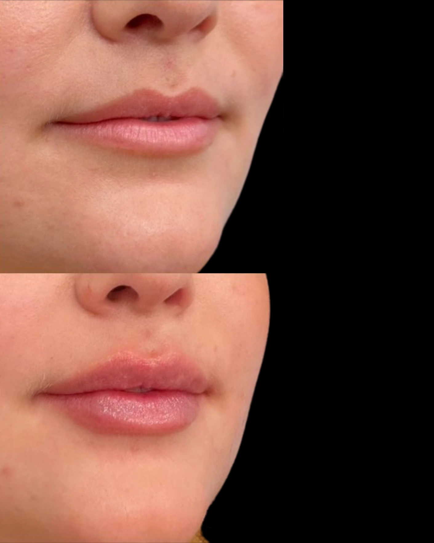Real Patient Results by Motykie Med Spa serving Beverly Hills & Los Angeles, CA