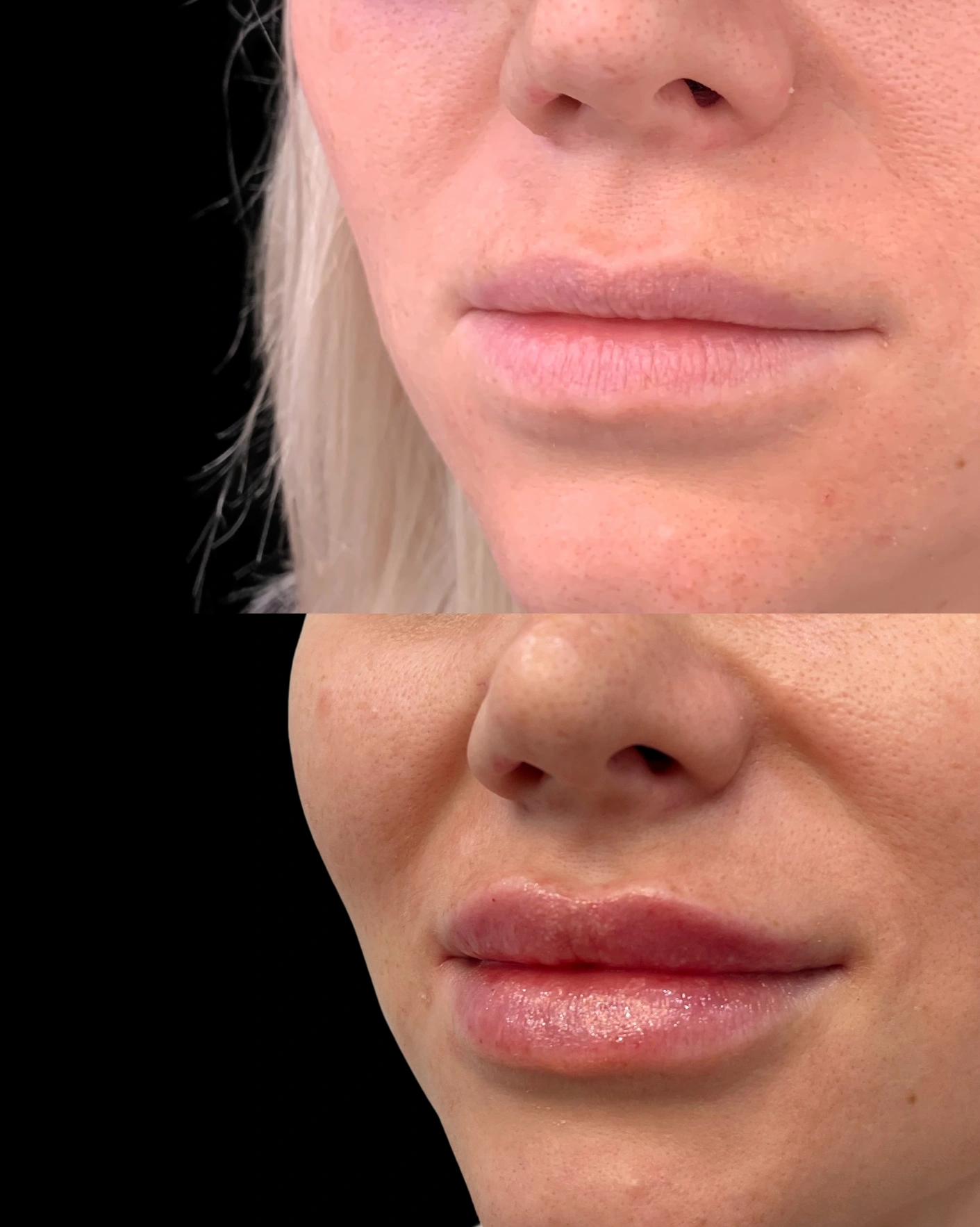 Real Patient Results by Motykie Med Spa serving Beverly Hills & Los Angeles, CA