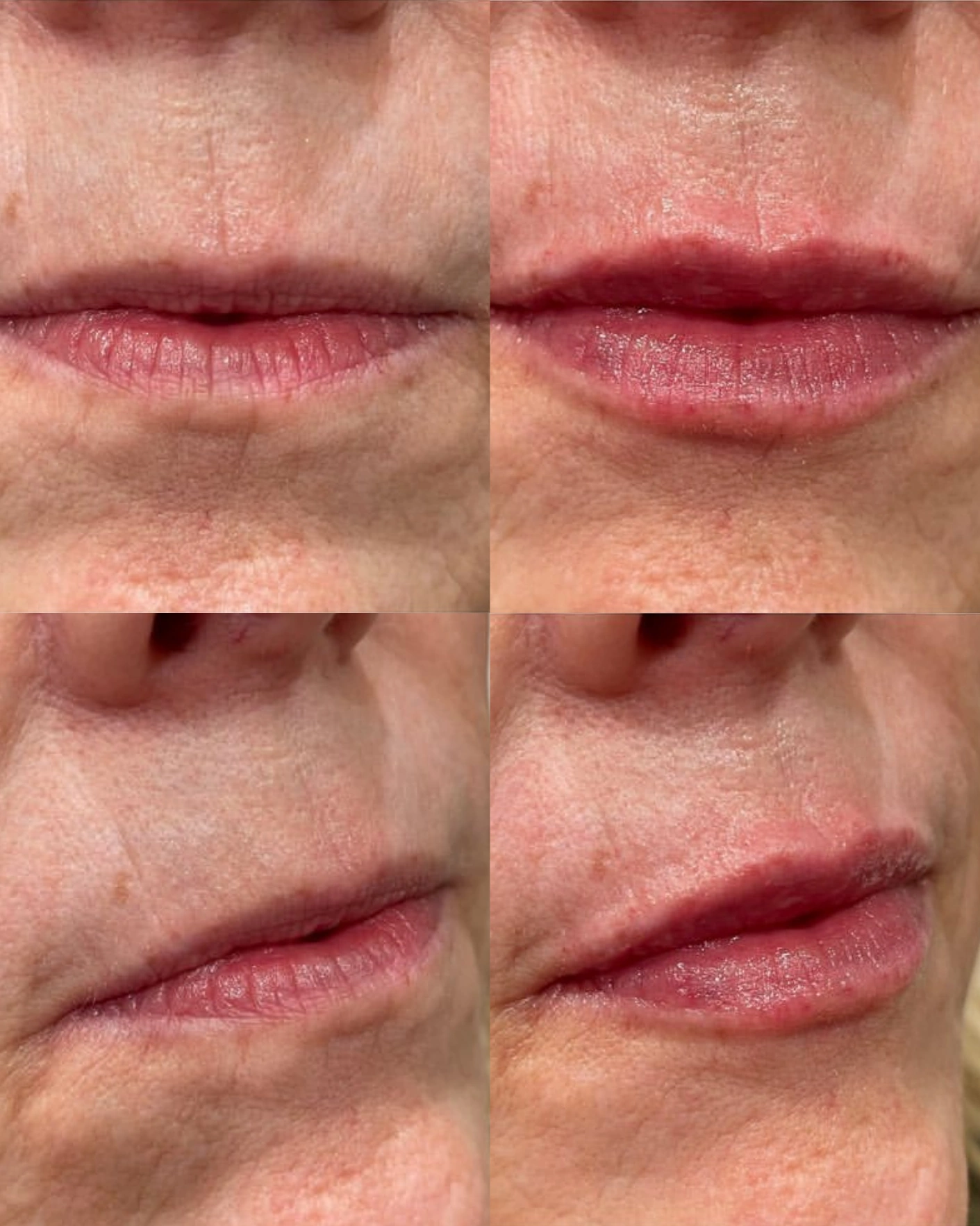 Real Patient Results by Motykie Med Spa serving Beverly Hills & Los Angeles, CA