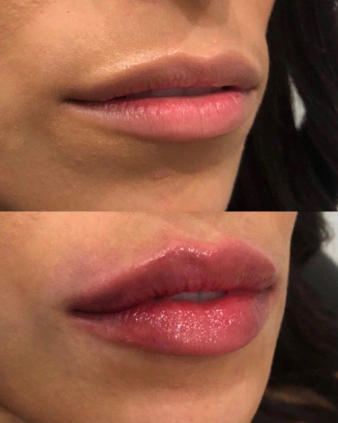 Real Patient Results by Motykie Med Spa serving Beverly Hills & Los Angeles, CA