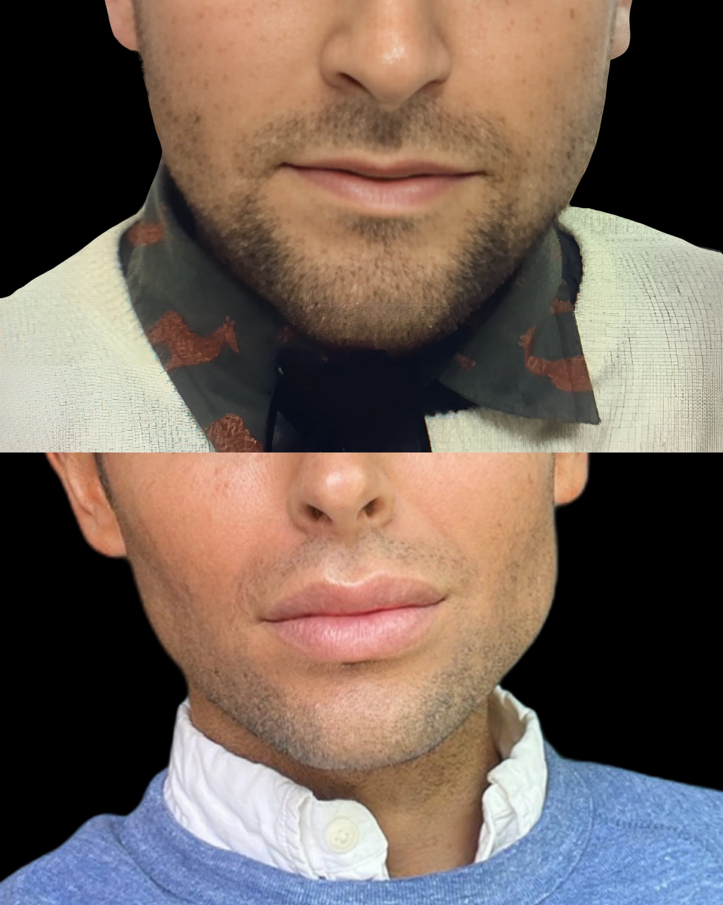 Real Patient Results by Motykie Med Spa serving Beverly Hills & Los Angeles, CA